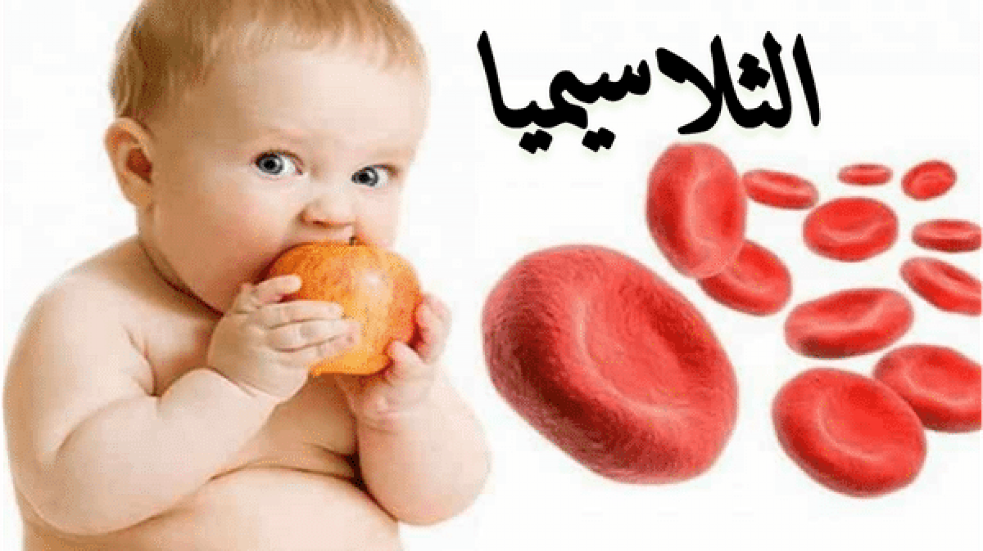 ماهو مرض ثلاسيميا بيتا عند الأطفال وماأنواعه وكيف يتم علاجه