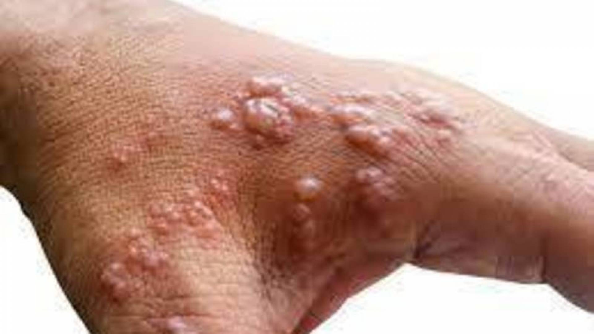 إسبانيا تسجل ثاني حالة وفاة بجدري القردة خلال يومين