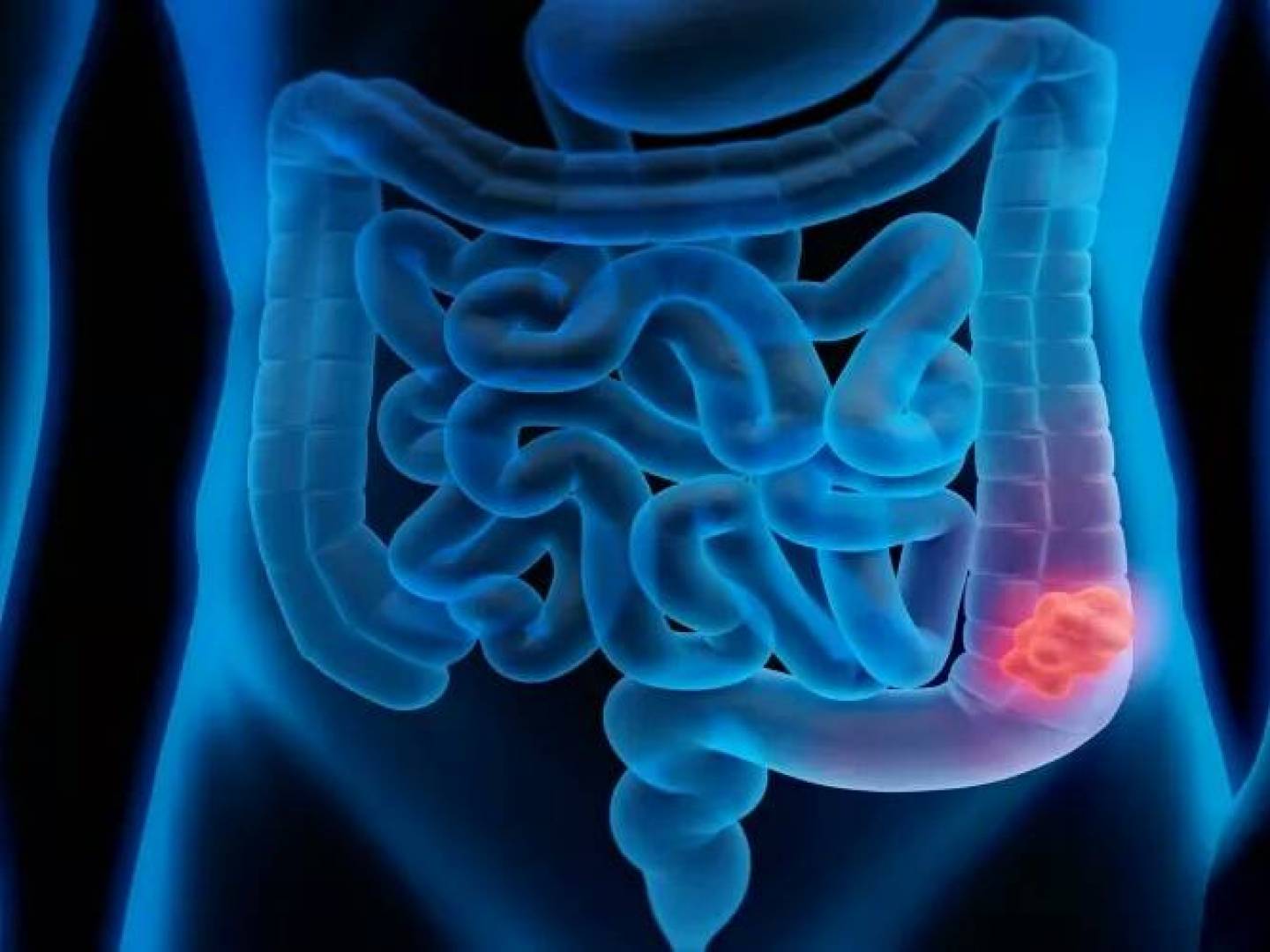 تعرف على العوامل المساعدة للإصابة بسرطان القولون