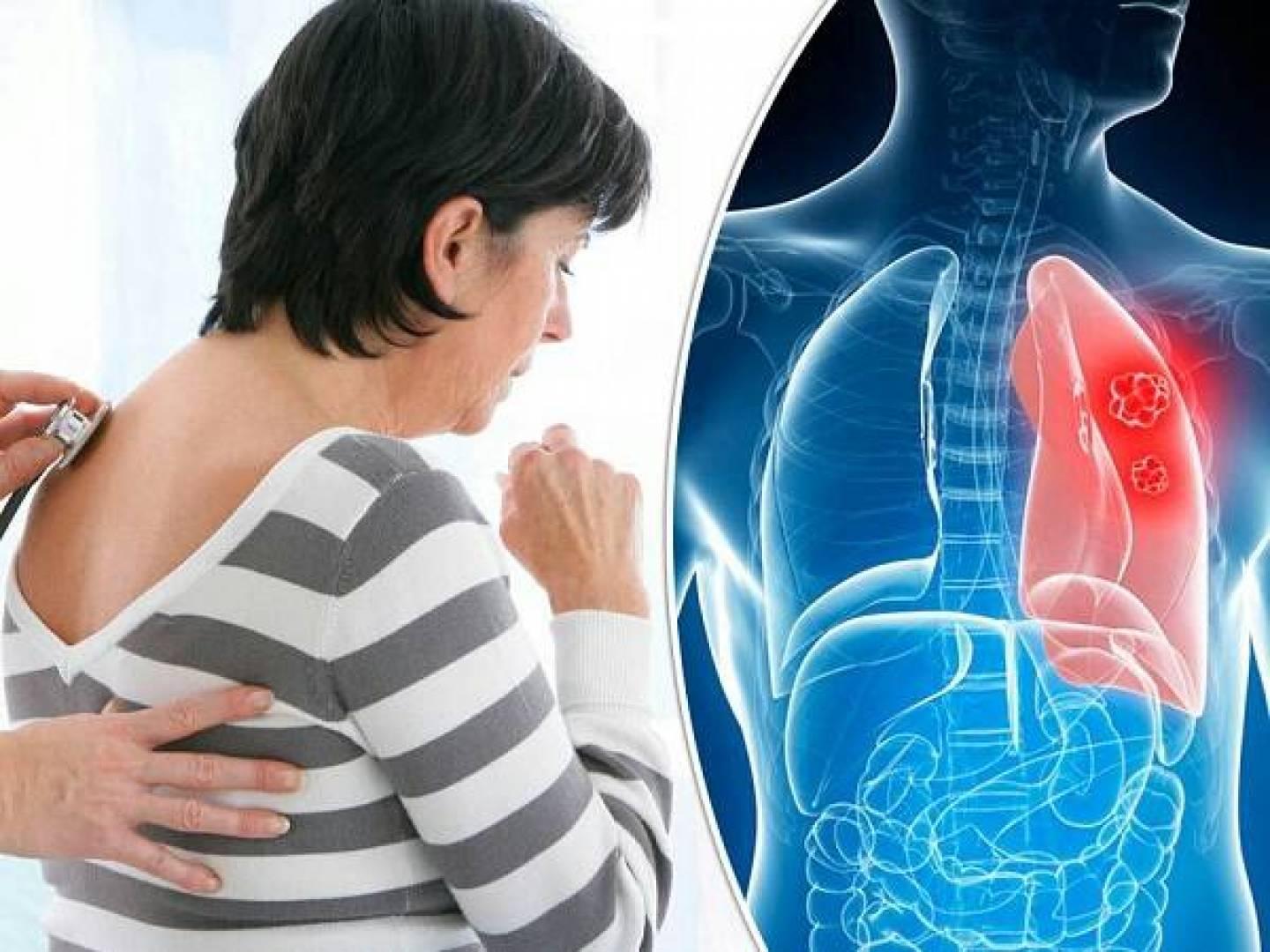 أعراض الإصابة بسرطان الرئة