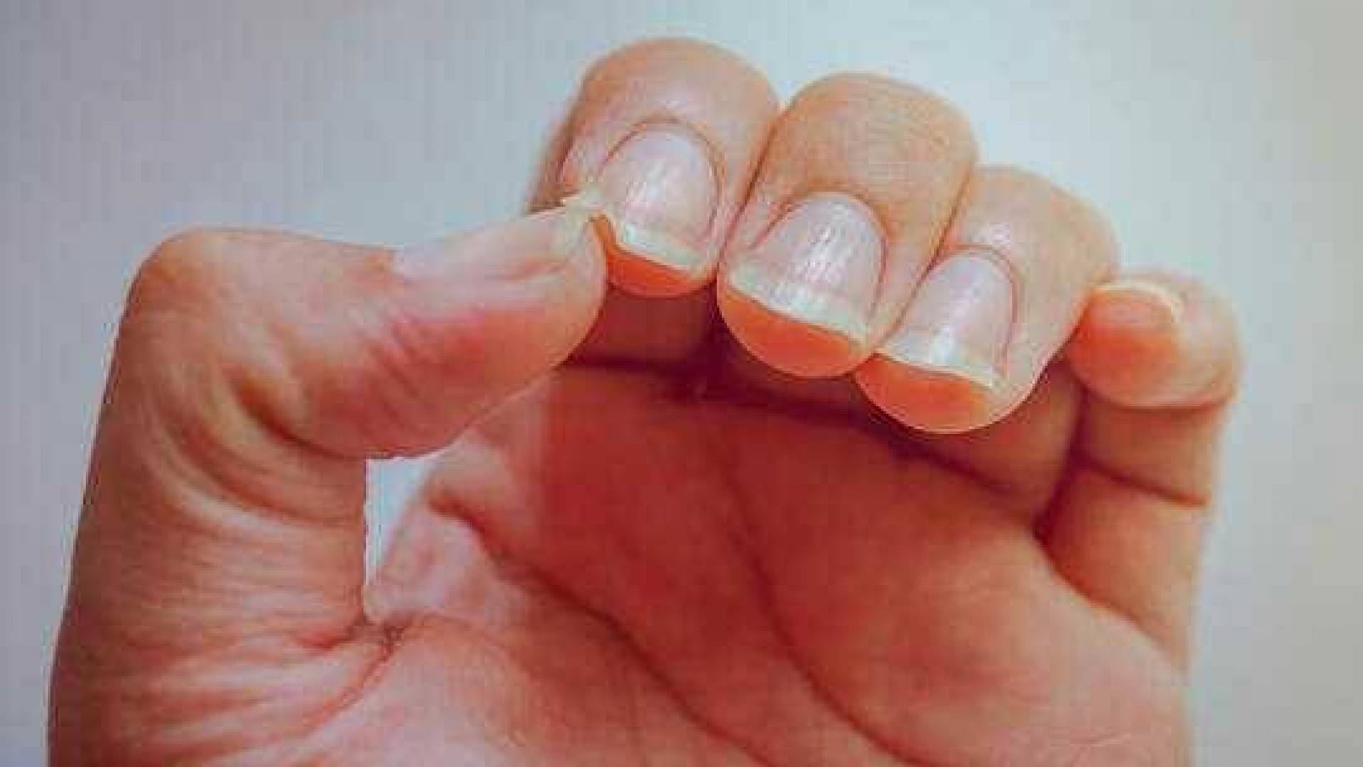 حالة أظافر الإنسان تعكس الكثير عن حالته الصحية .. إليك التفاصيل