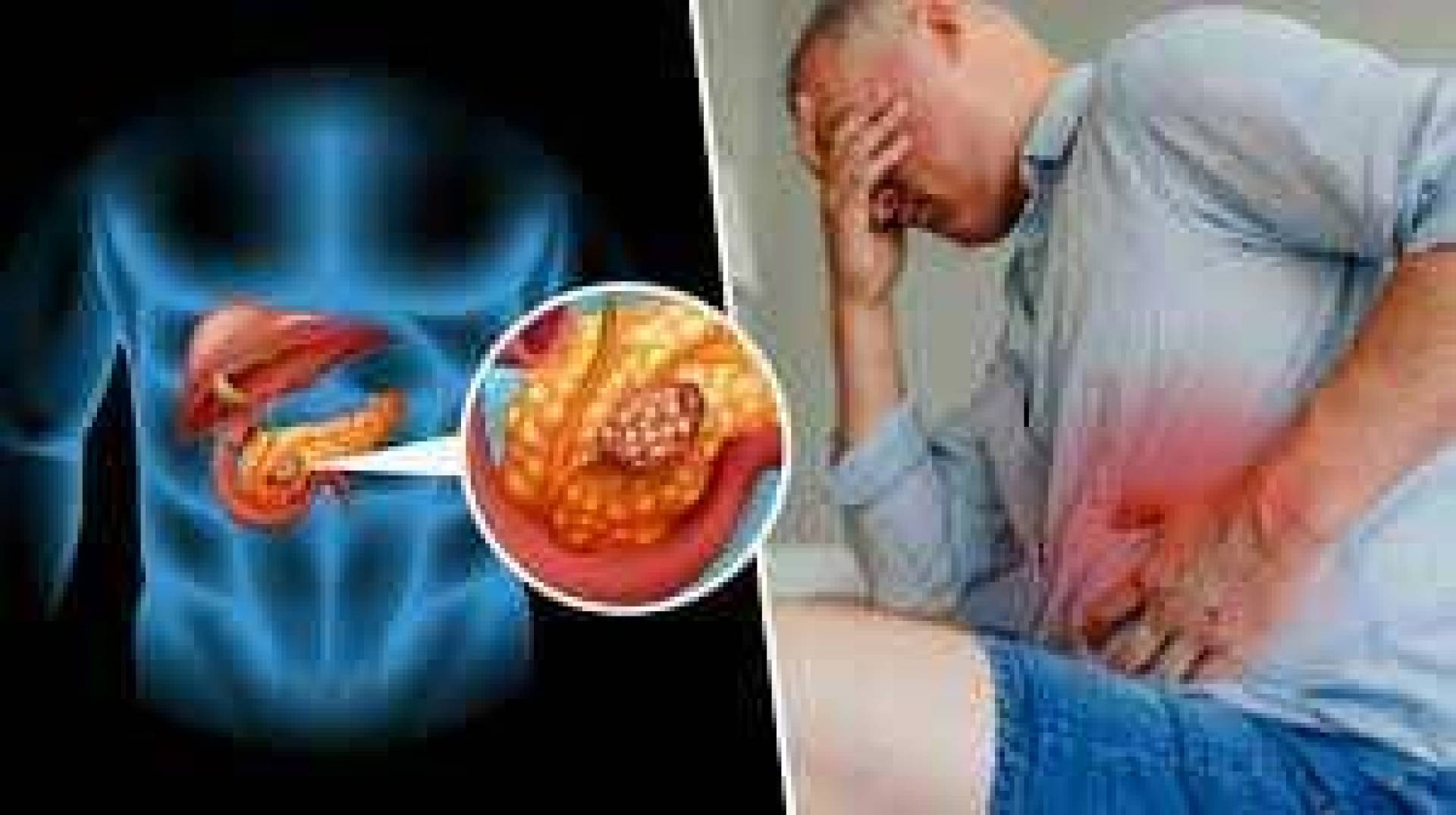 علامة تحذير قد تظهر في المرحاض تكشف عن إصابتك بسرطان البنكرياس