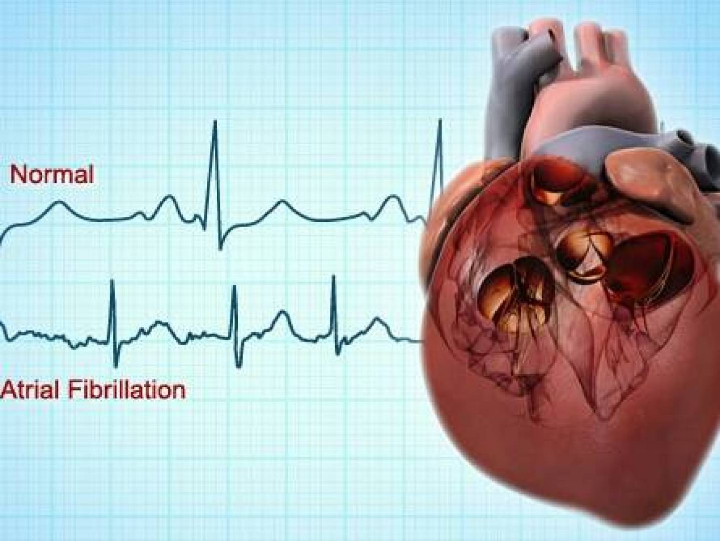 أسباب اضطراب نبضات القلب وحدوث الرجفان الأذيني