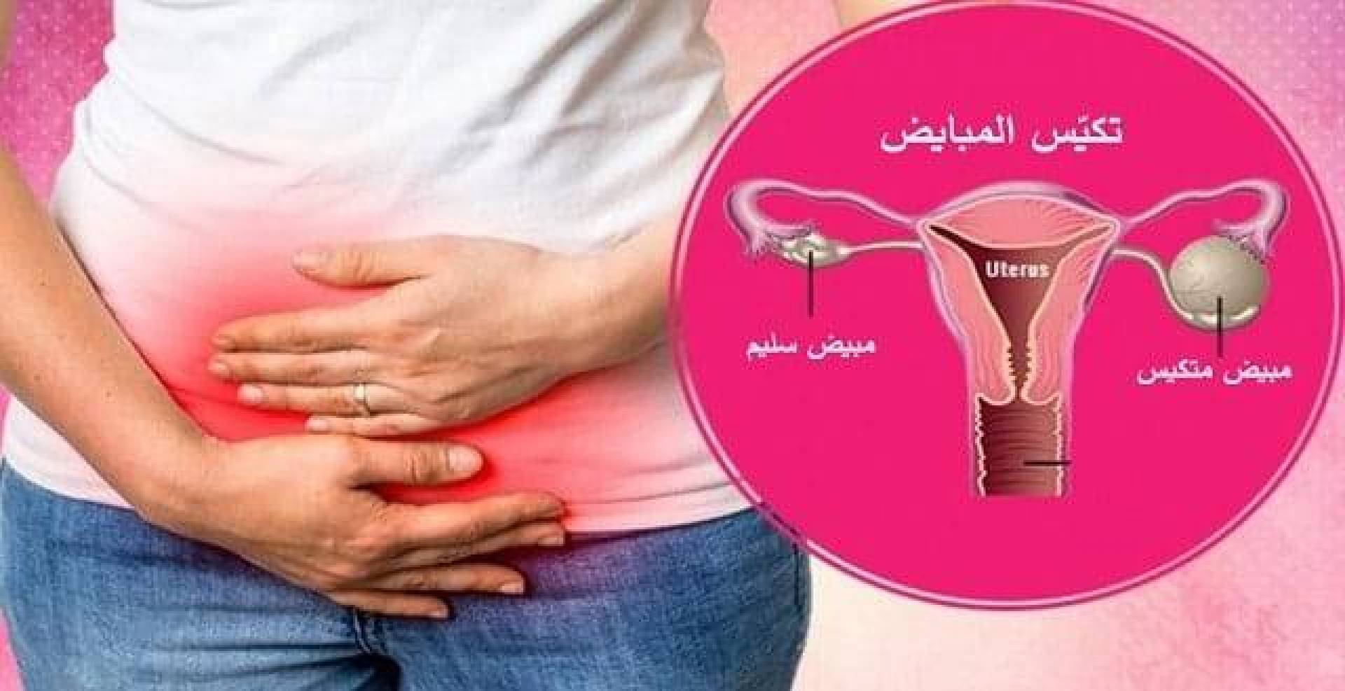 الأدوية المستخدمة في علاج تكيس المبايض عند المتزوجة