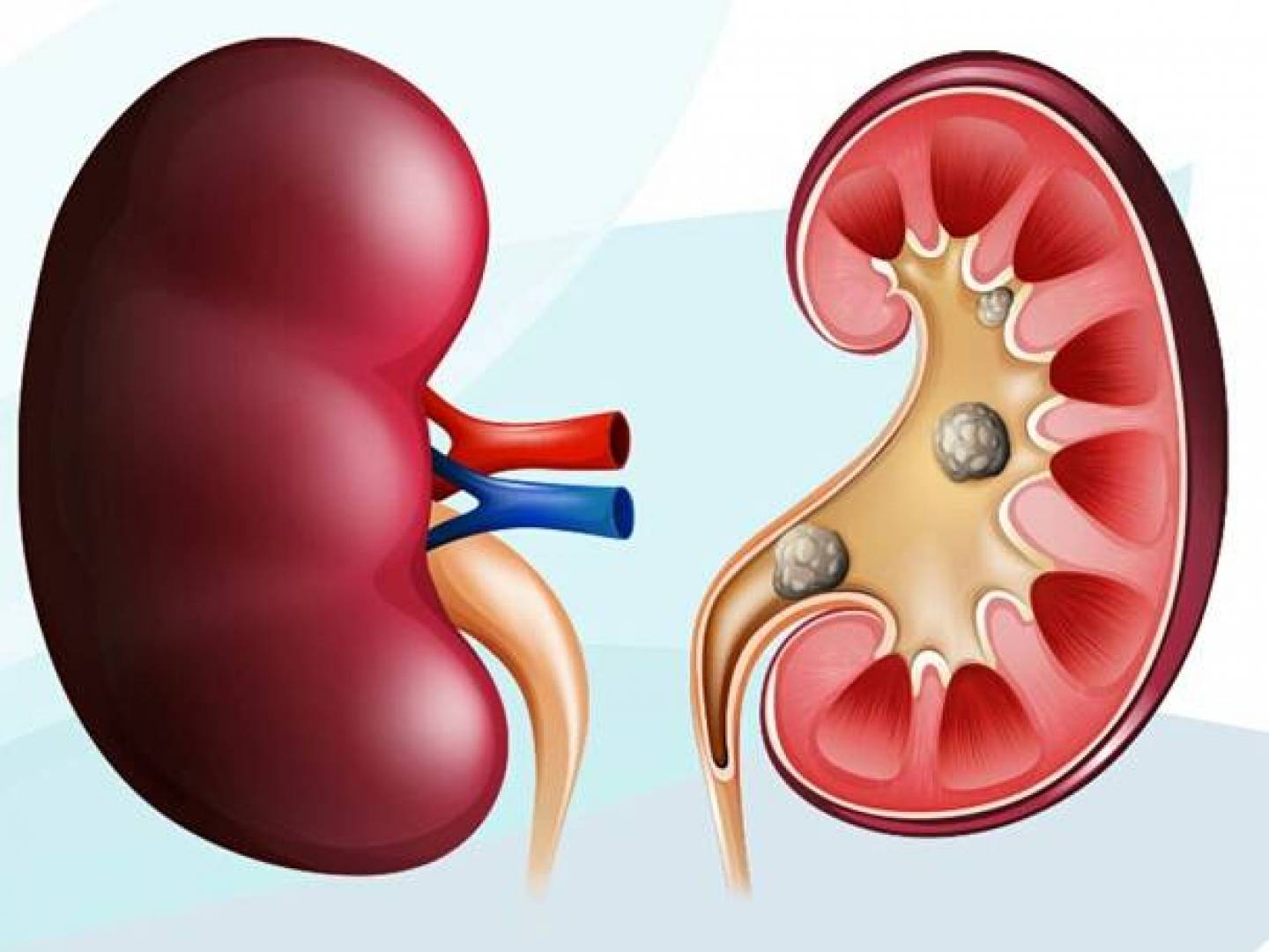 مفاهيم وخرافات خاطئة عن حصوات الكلى