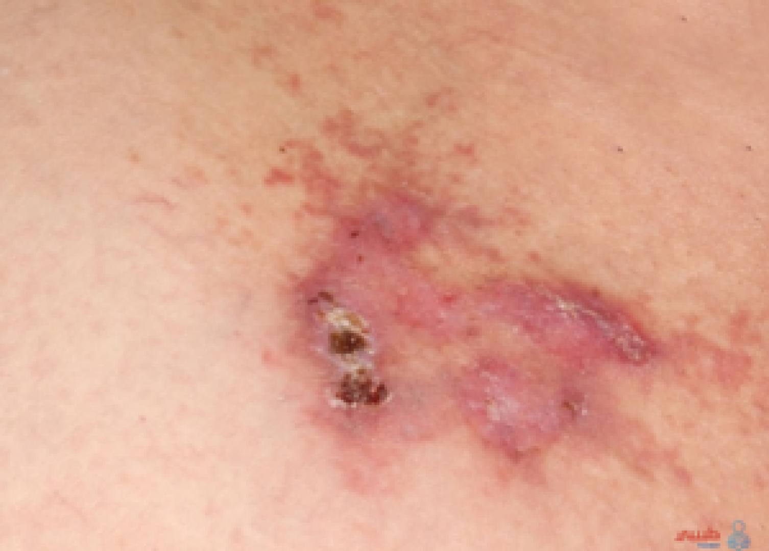 ماهي الساركومة الوعائية وما اسبابها وأعراضها وطرق علاجها