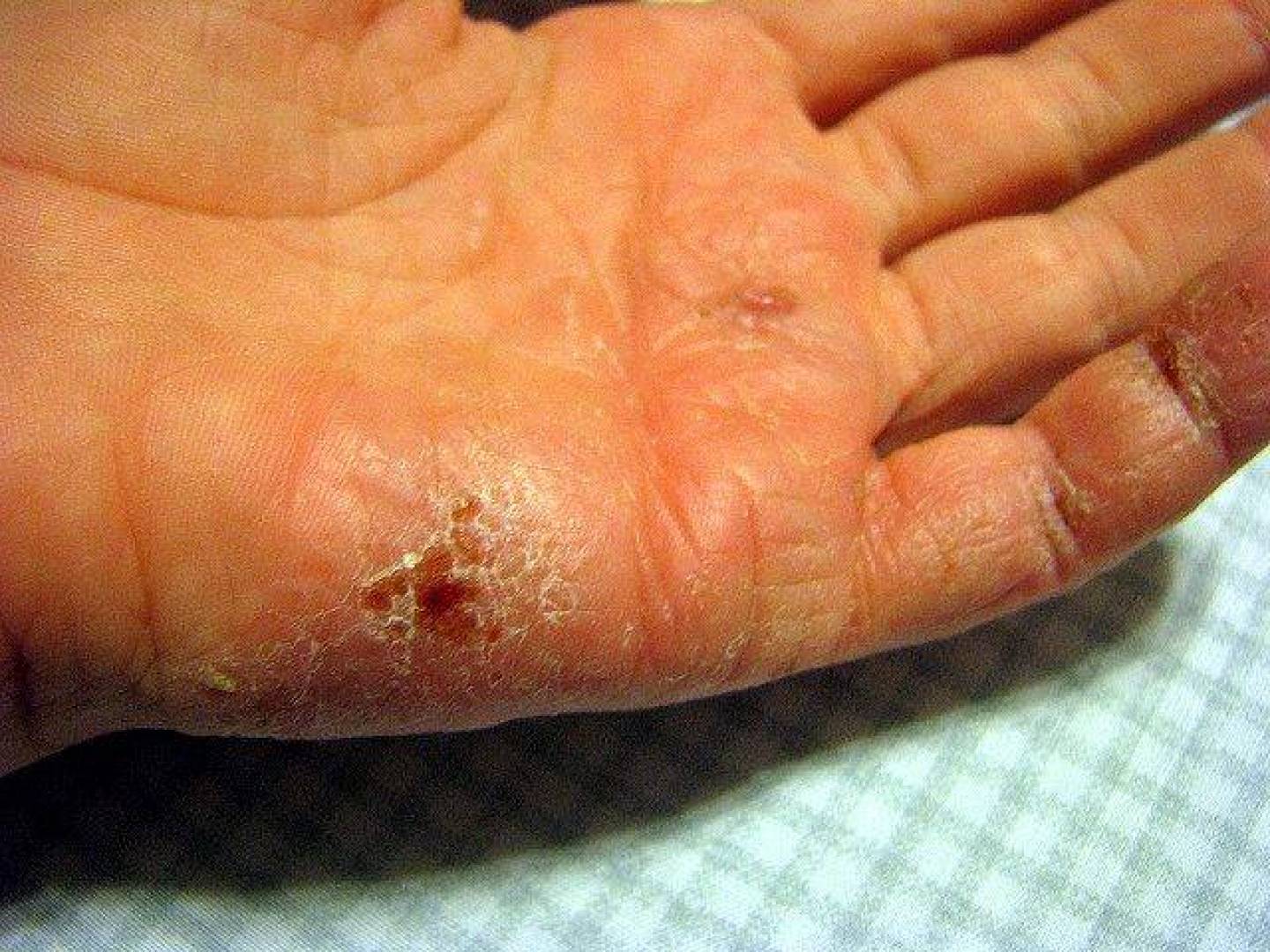 ما هي مخاطر الإصابة بالإكزيما وما أعراضها