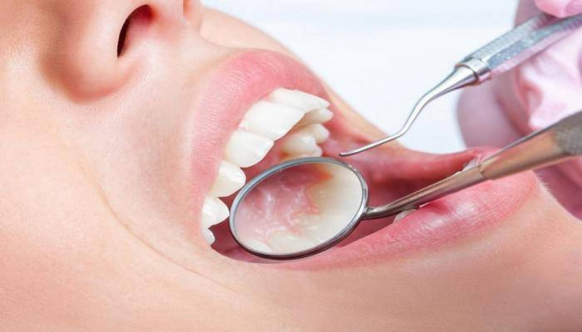 الأعراض الرئيسية للإصابة بسرطان الفم