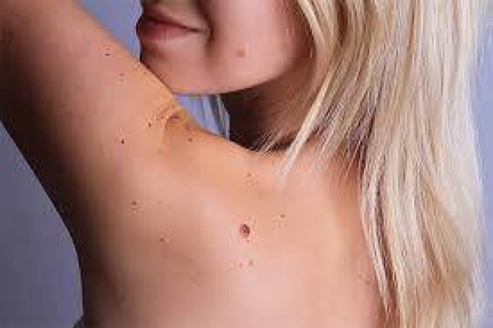 ما هي الشامات ولماذا تظهر ومتى يجب فحصها