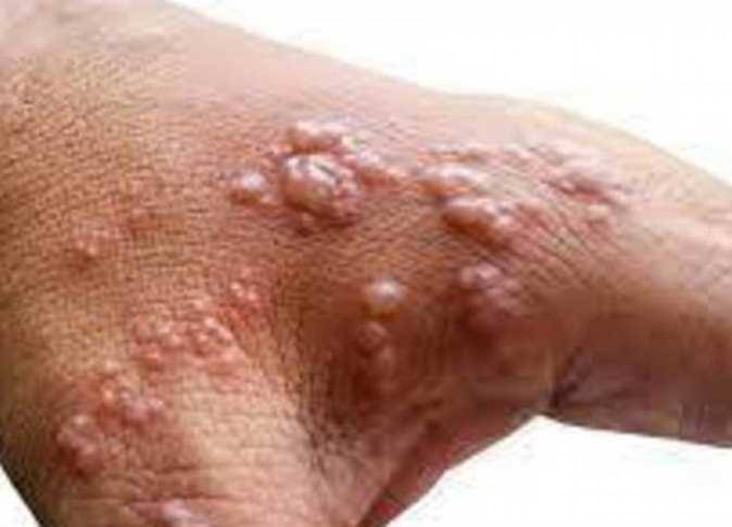 أهم الأسئلة والأجوبة عن جدرى القرود وطرق الوقاية