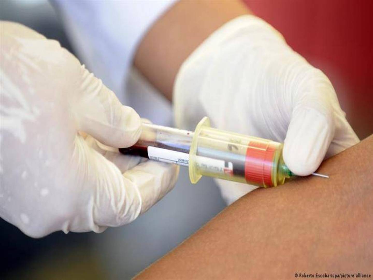 علاج جديد عن طريق الحقن لمكافحة فيروس نقص المناعة البشرية