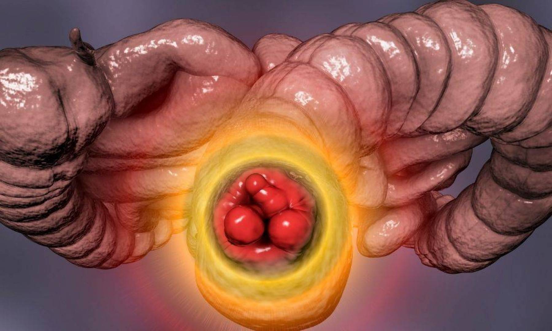 كل ماتريد معرفته عن البواسير