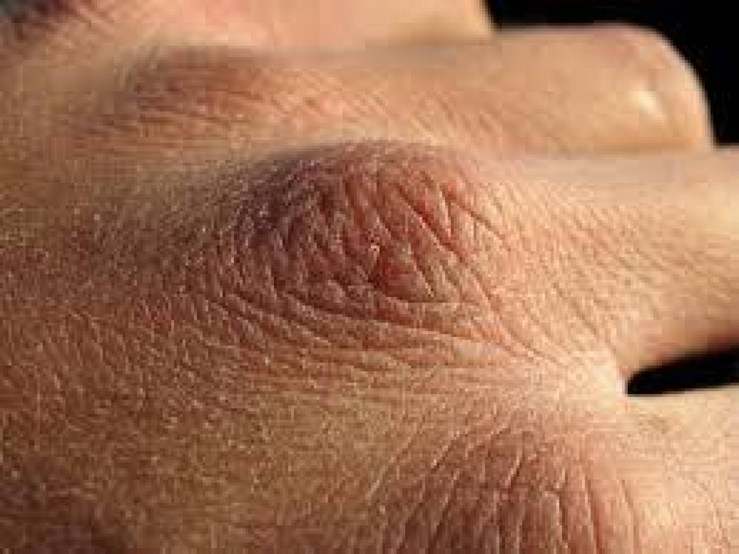 نصائح هامة للتخلص من جفاف اليدين والجلد في فصل الشتاء