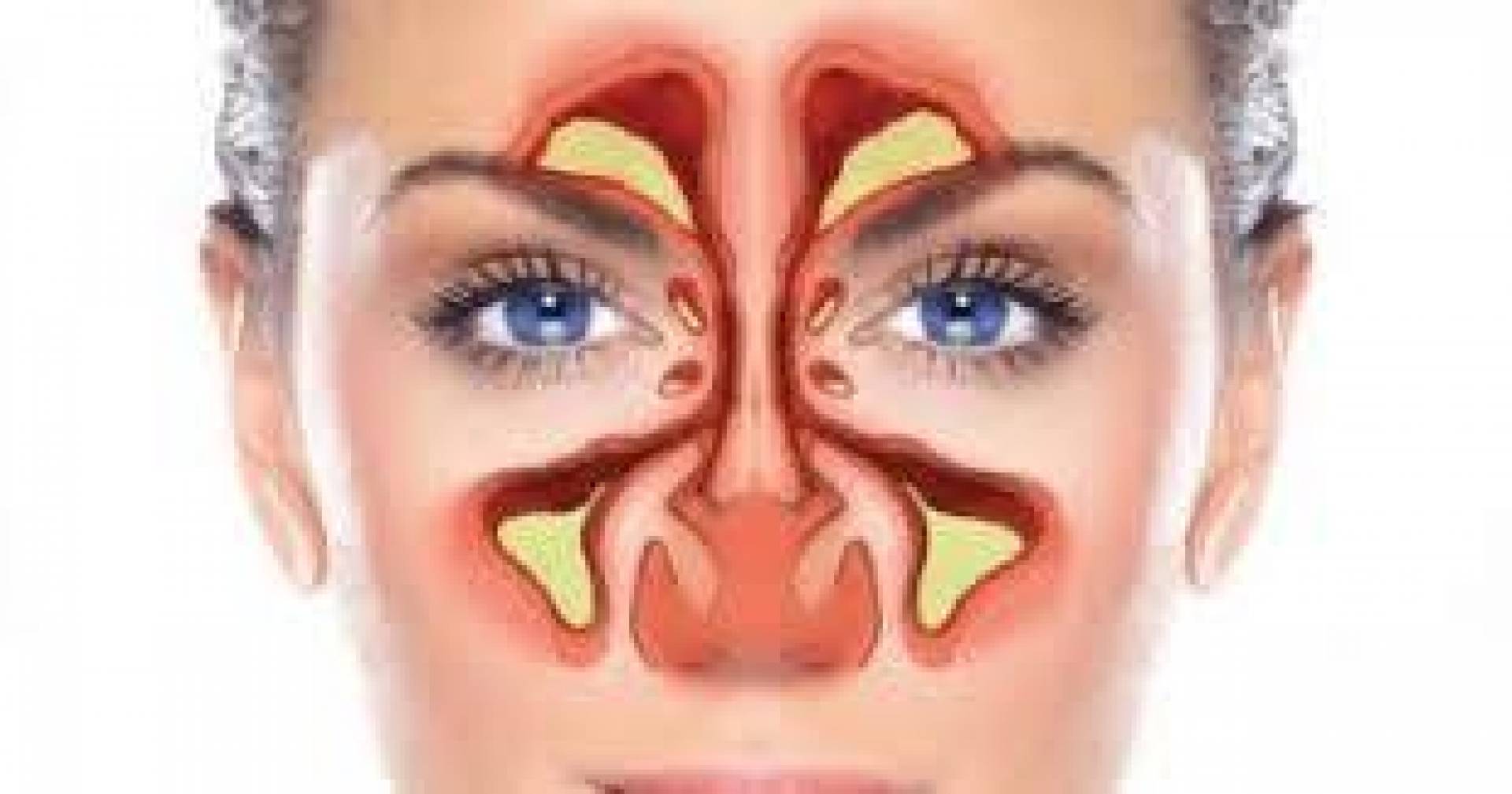 التهاب الجيوب الأنفية الحاد : أسبابه أعراضه وطرق تجنبه