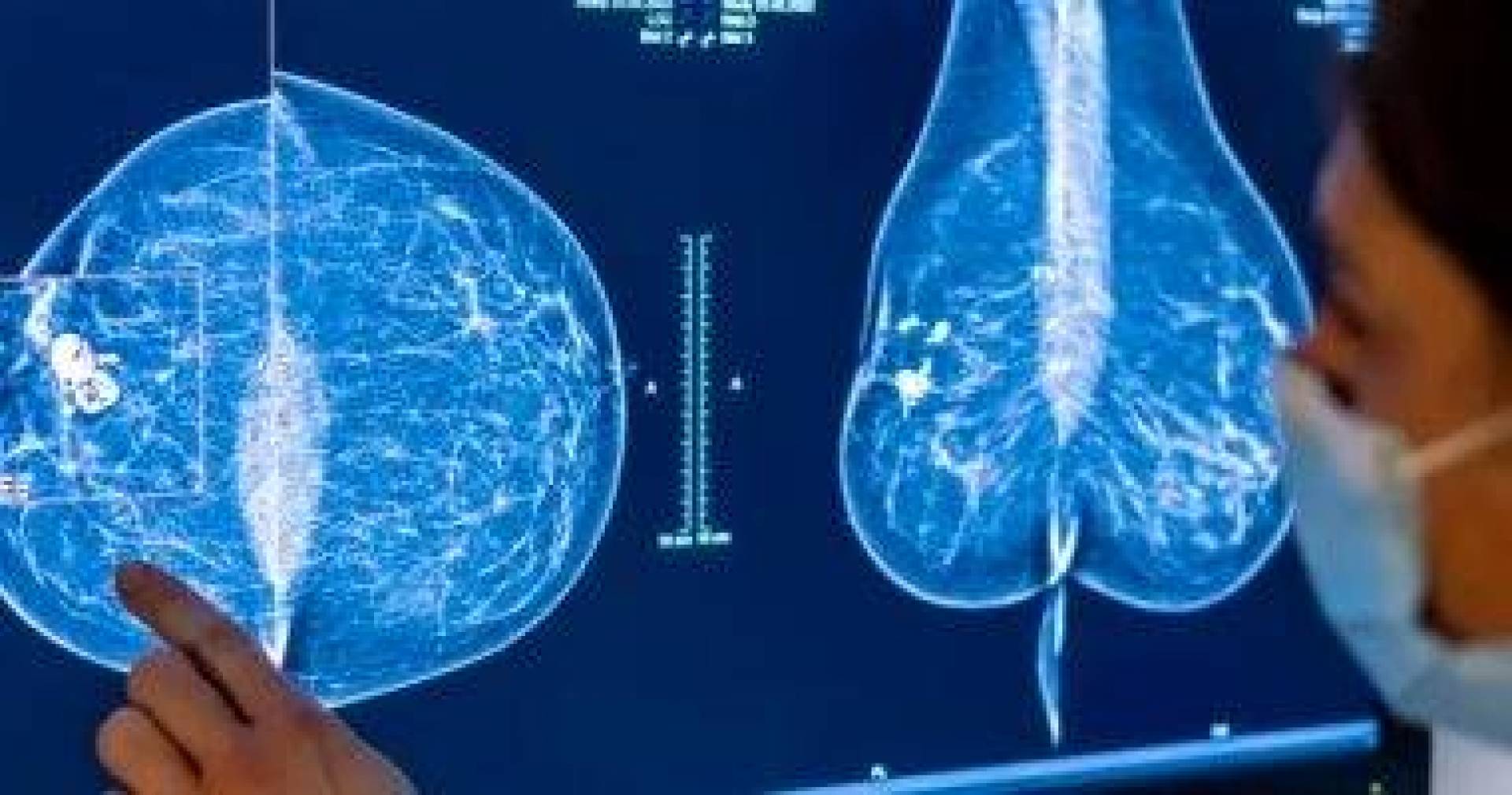الذكاء الاصطناعي يكشف عن سرطان الثدي بدقة تفوق الأطباء