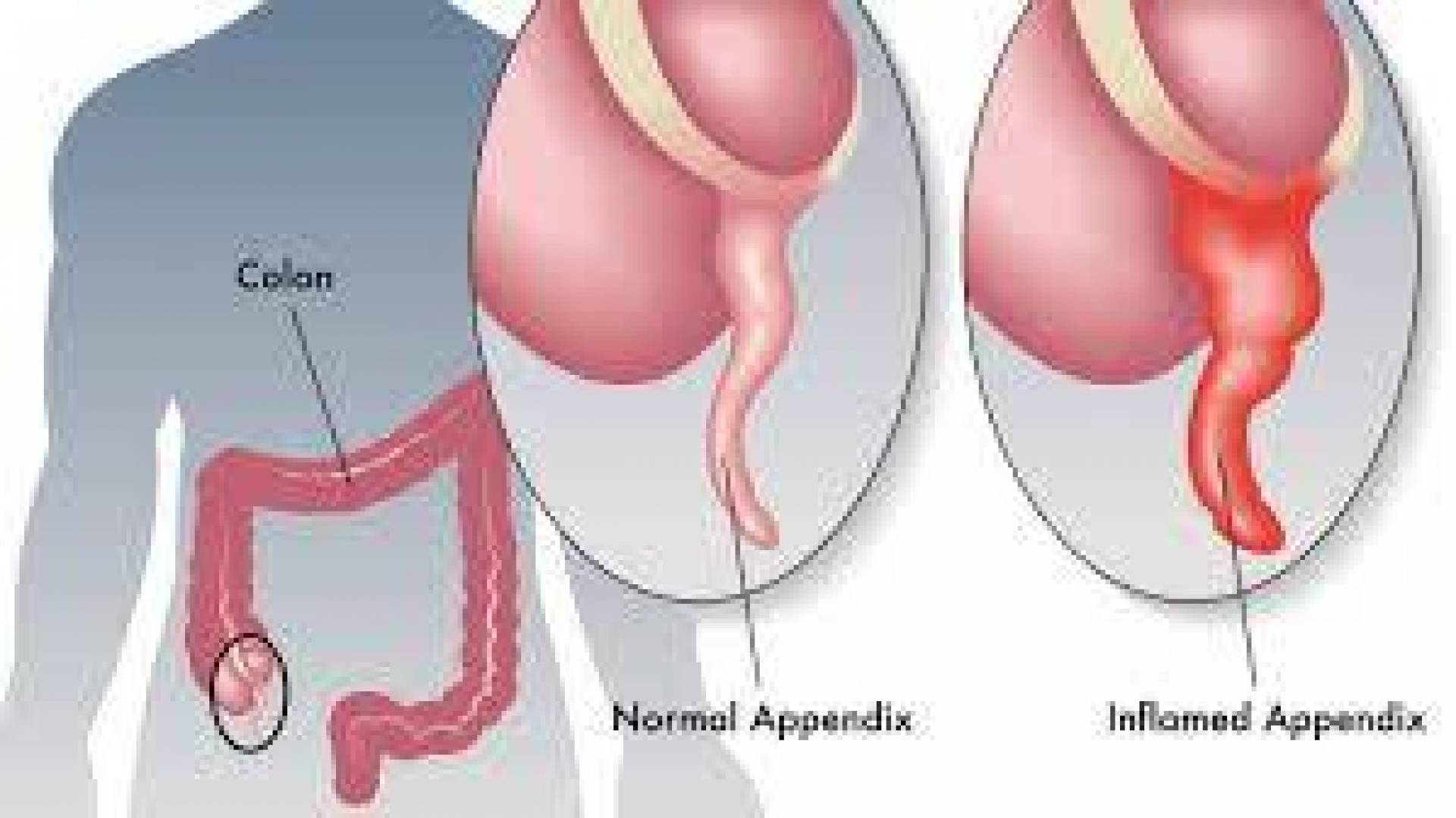 أعراض التهاب الزائدة الدودية وأسبابها وعلاجها