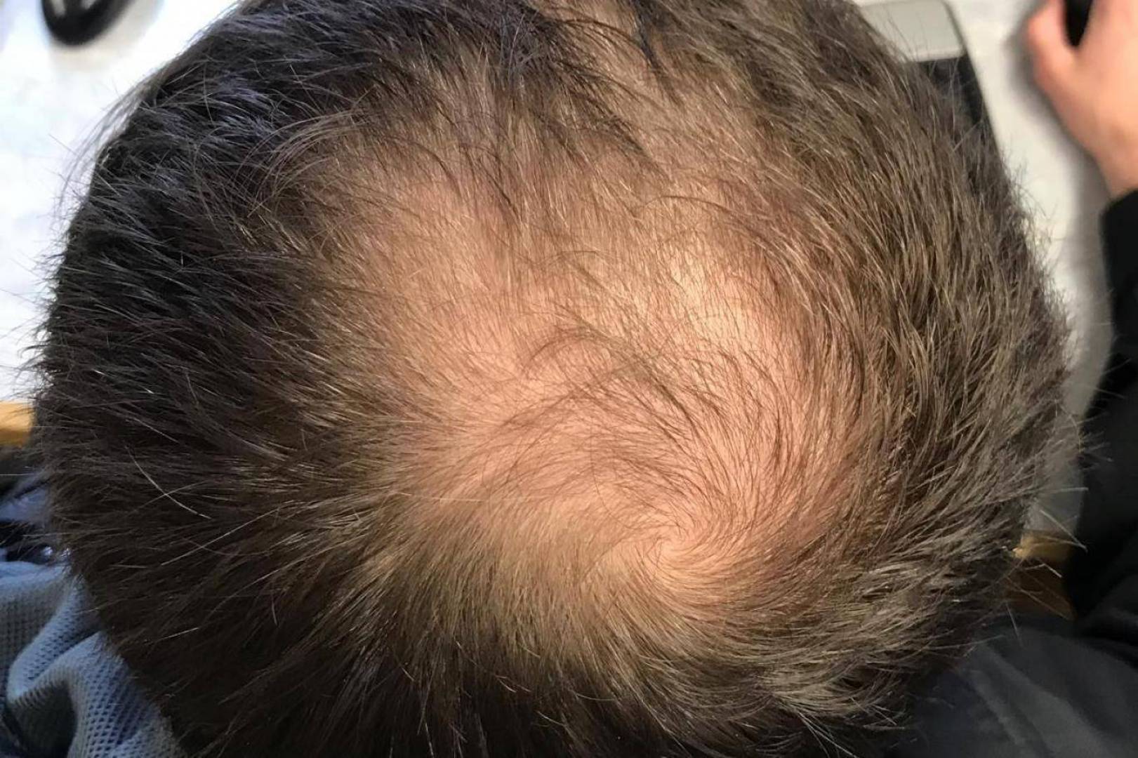 كل ما تريد معرفته عن زراعة الشعر بالخلايا الجذعية