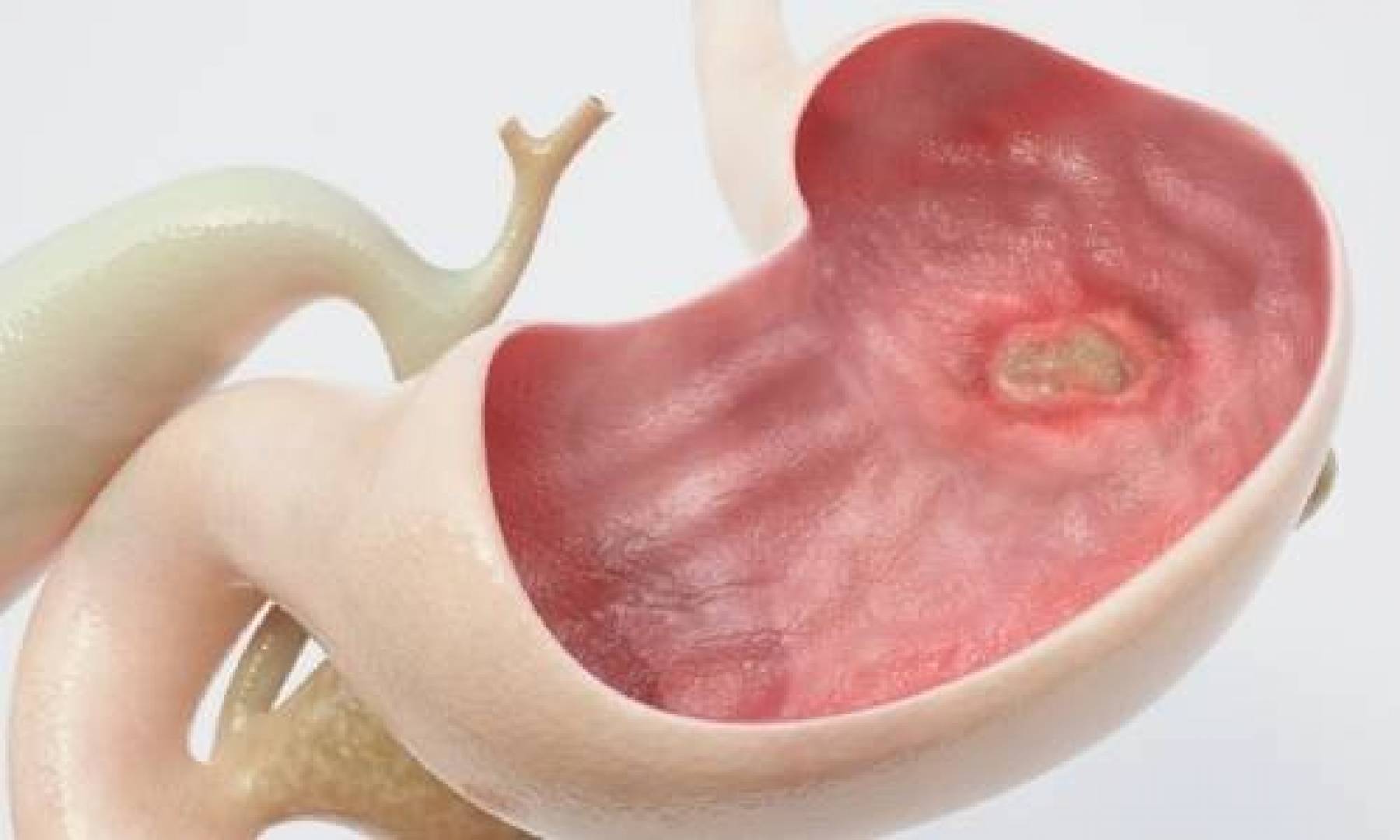 أطعمة غنية بالفلافونويد للوقاية من قرحة المعدة