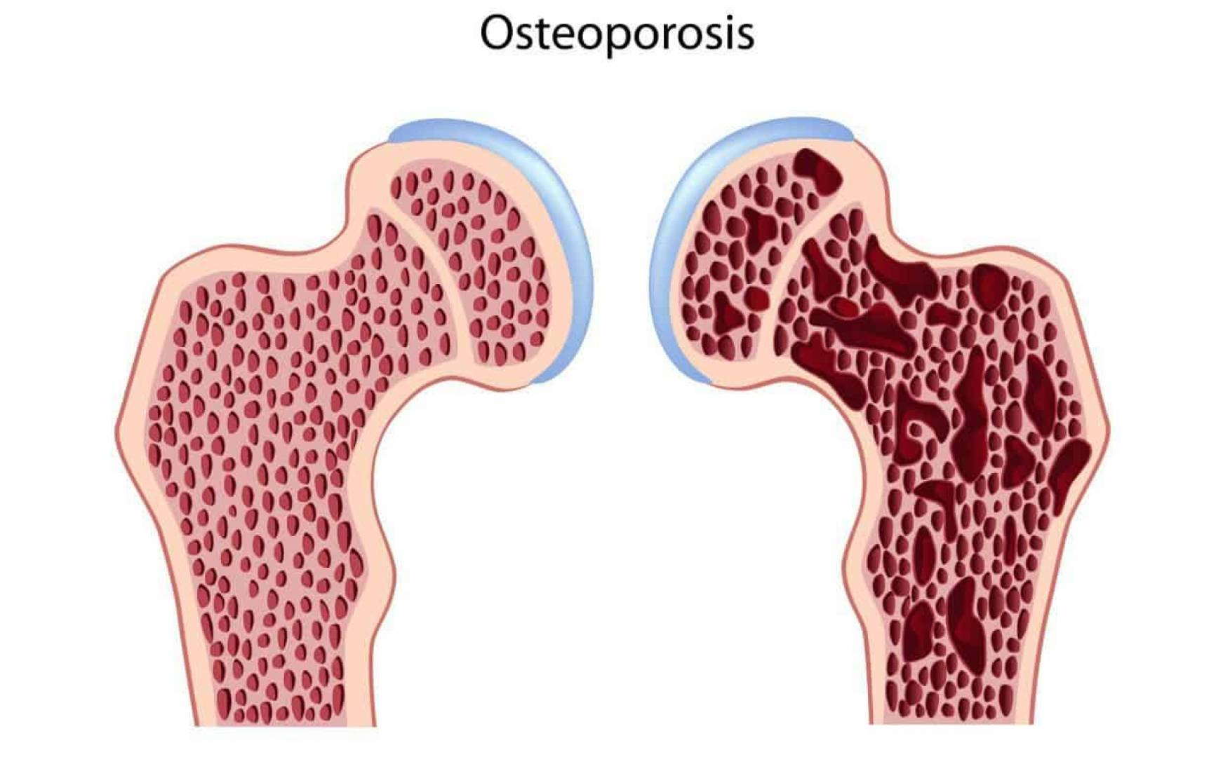 كل ما تريد معرفته عن اختبار كثافة العظام
