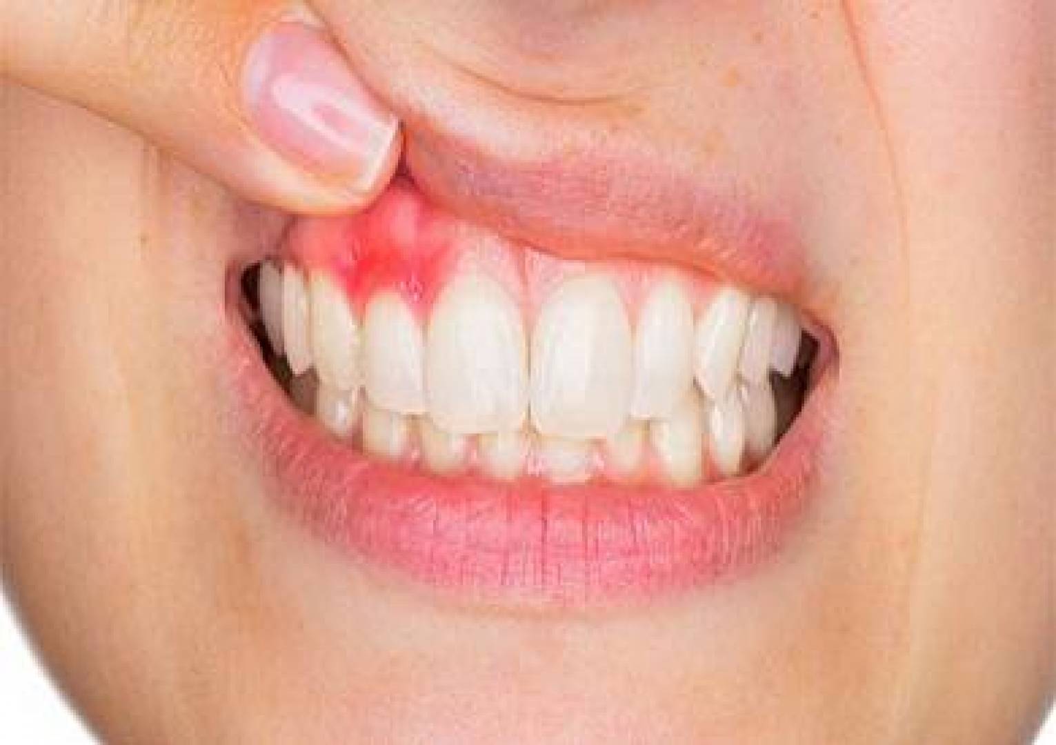 أسباب خراج الأسنان وأعراضه وطرق الوقاية منه وعلاجه