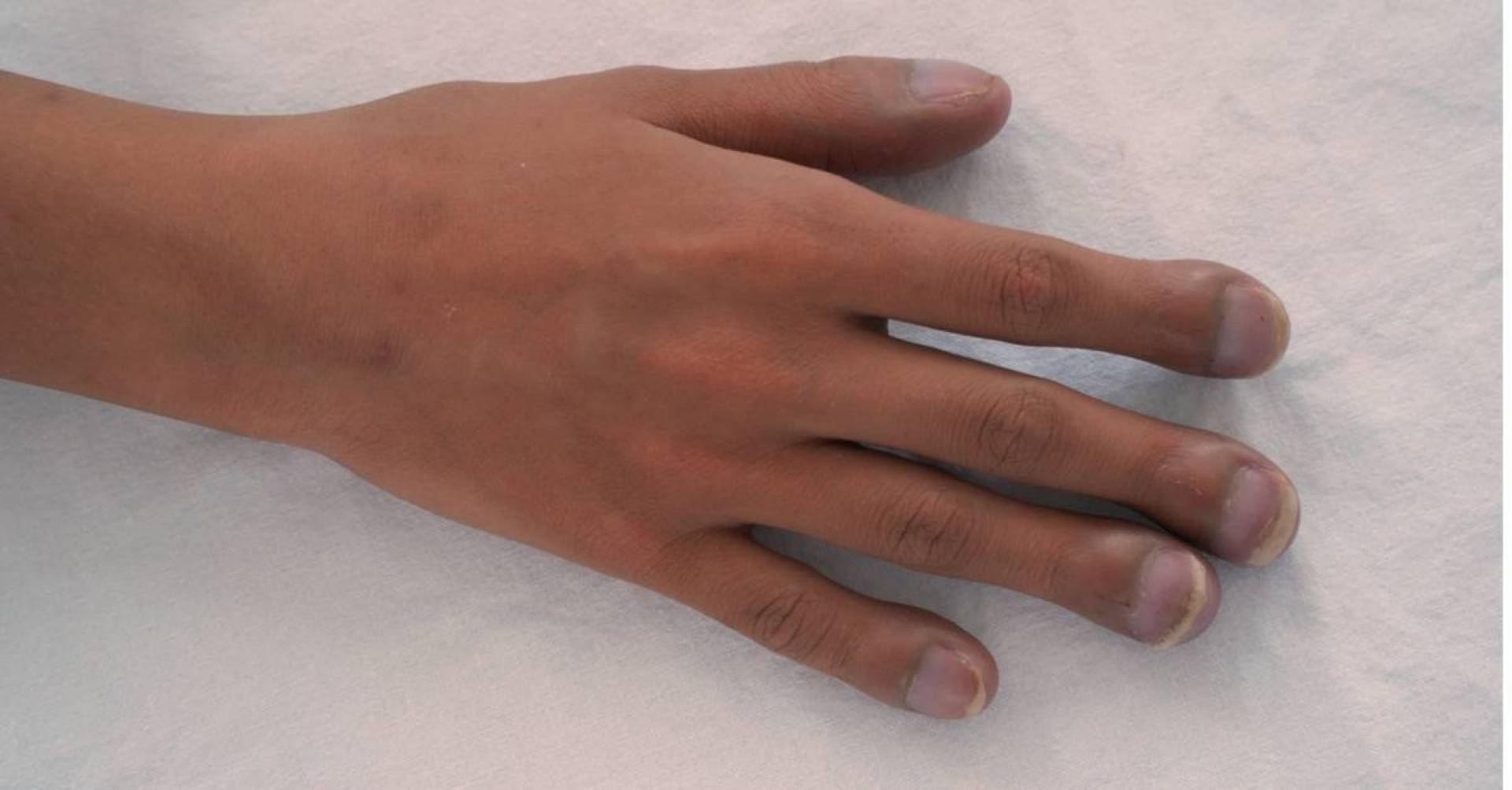 تعجر الأصابع مؤشر على احتمالية الإصابة بسرطان الرئة ..إليك التفاصيل