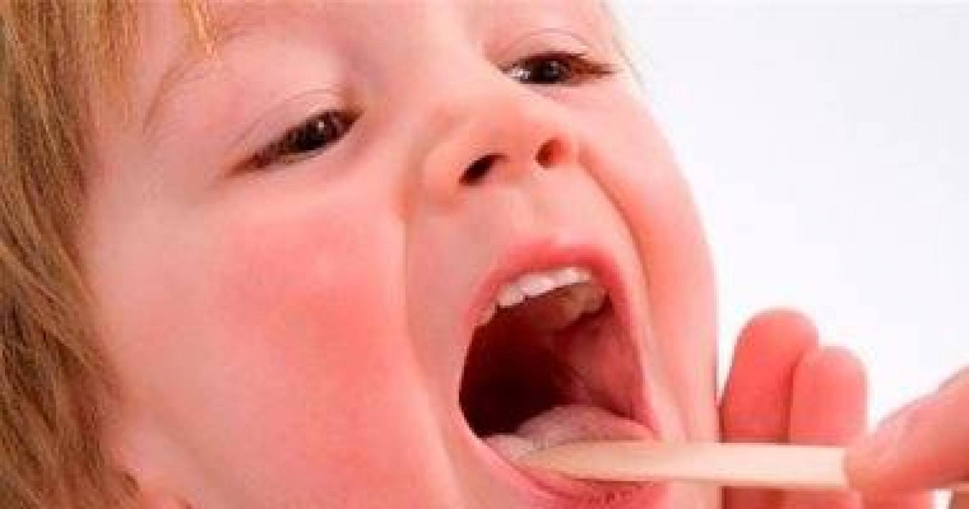 ماهي خطورة التهاب اللوزتين العقدي ومتى يجب استىصالهم ؟