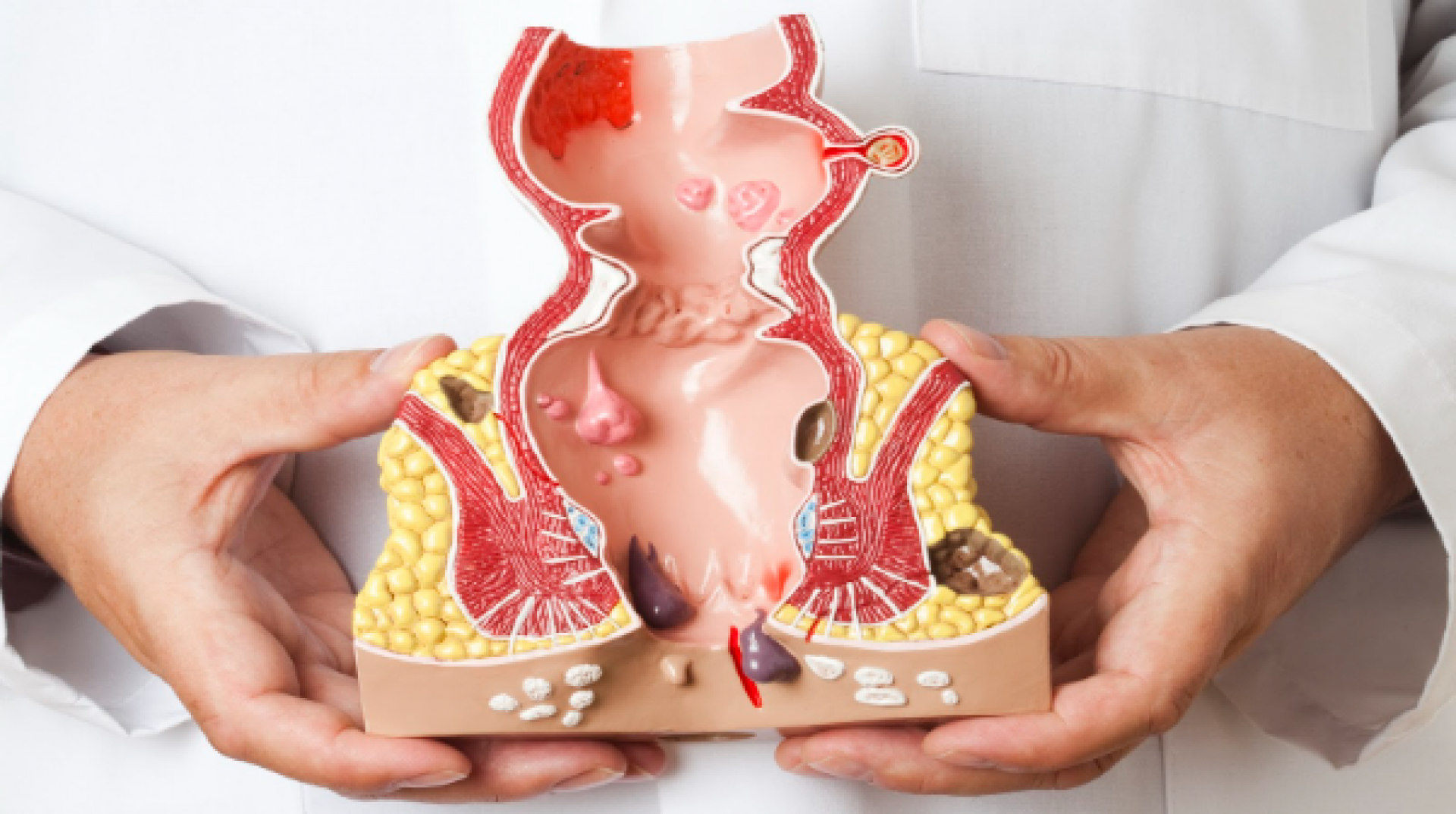 ماهو الفرق بين أعراض البواسير وسرطان المستقيم ؟