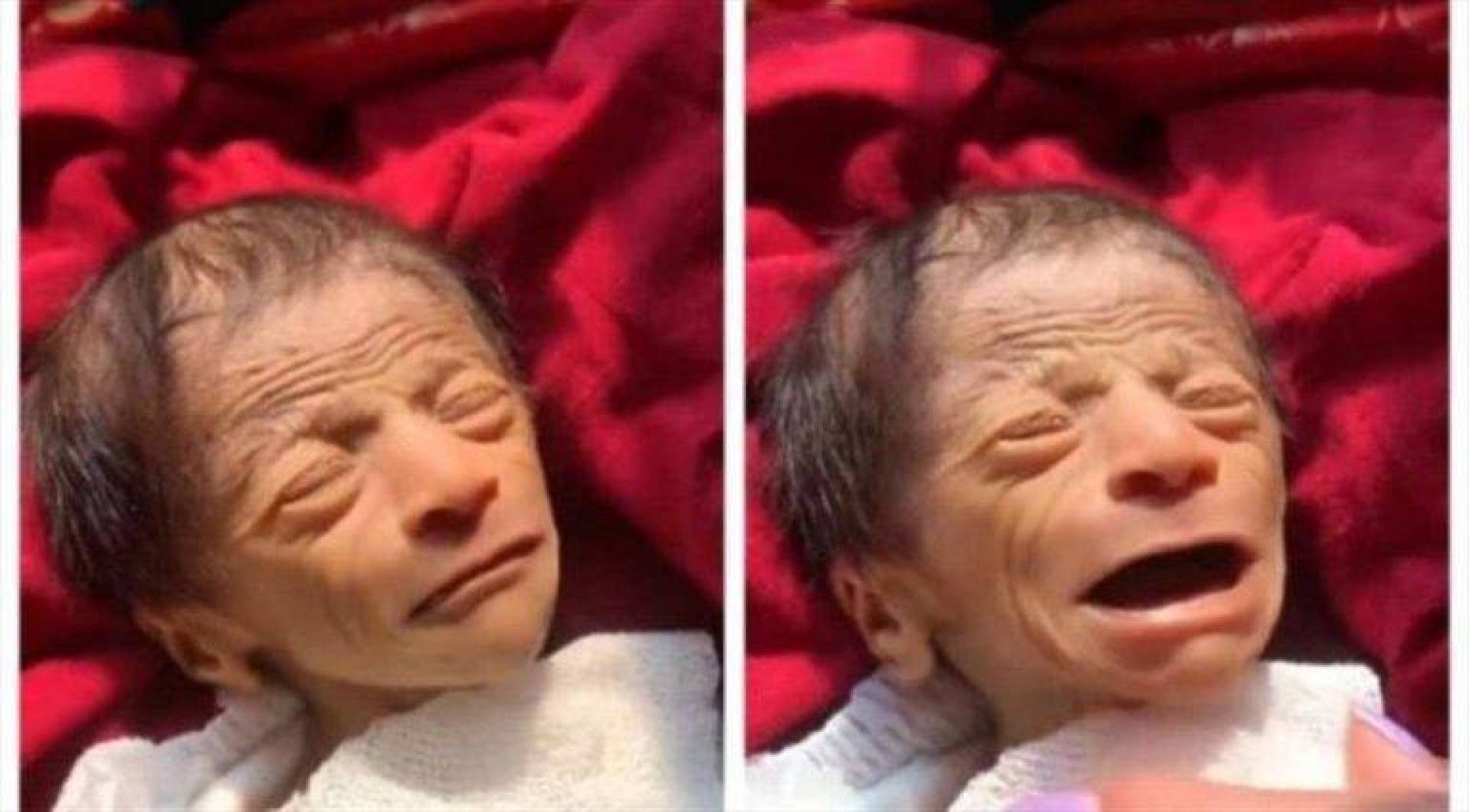 حقيقة “الطفل العجوز” حديث السوشيال ميديا