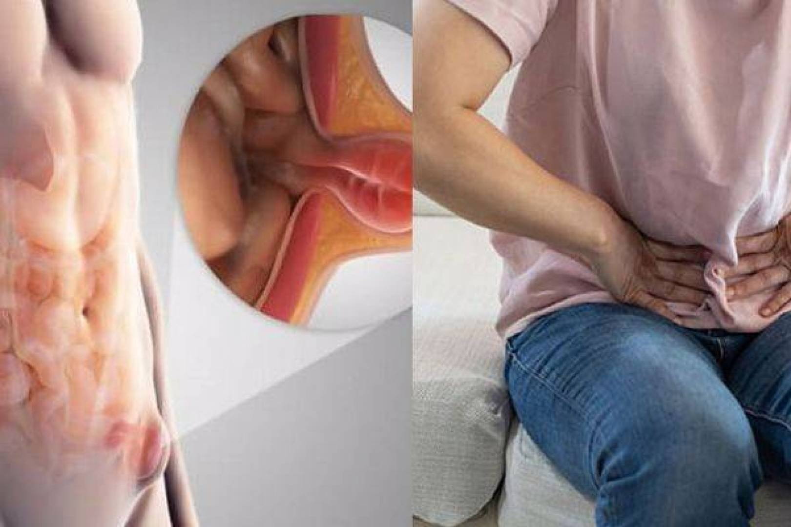 الفتق الإربي .. أعراضه تشخيصه وخطورته
