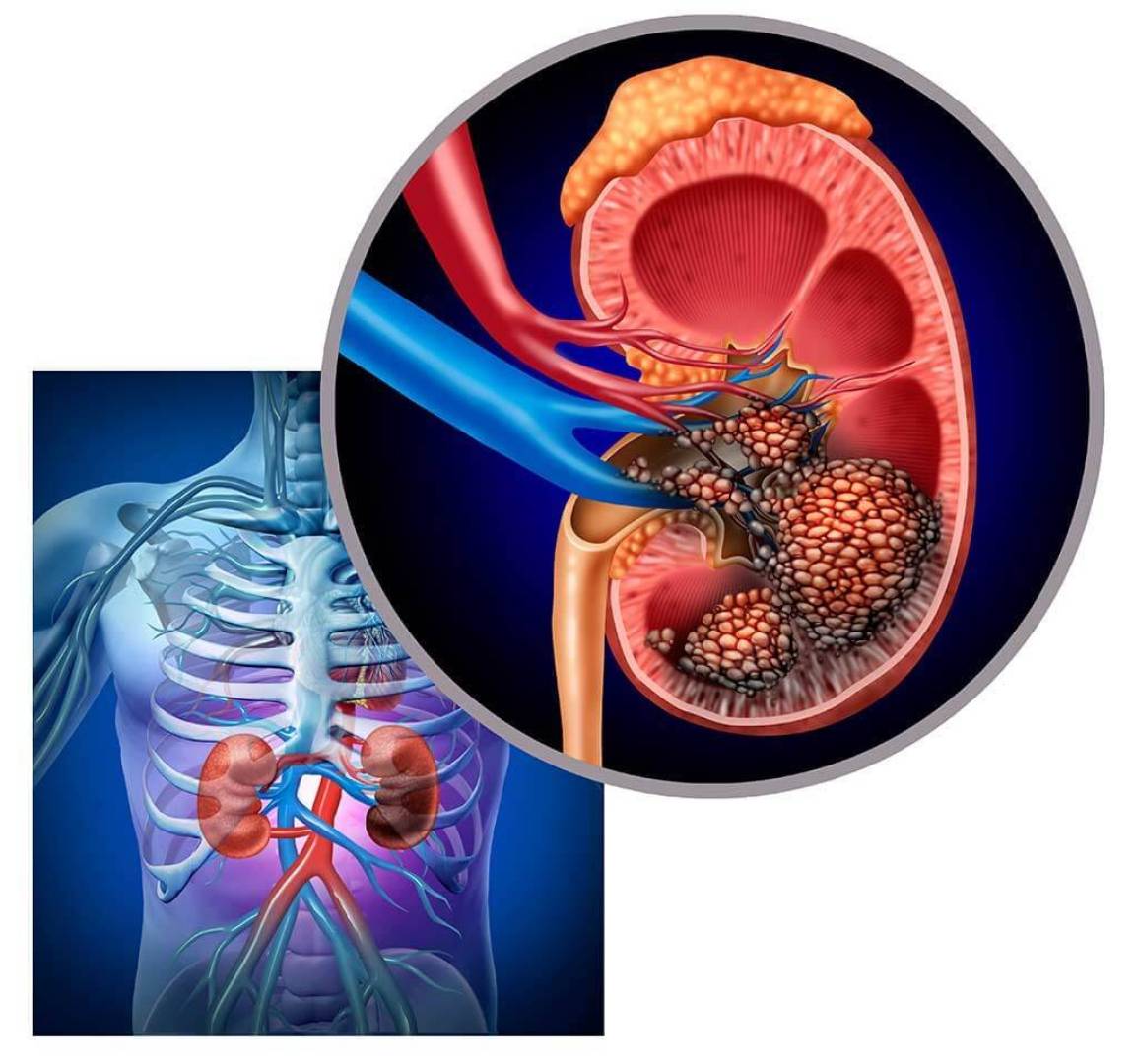 الأعراض المبكرة لسرطان الكلى وأهمية الكشف المبكر عنه