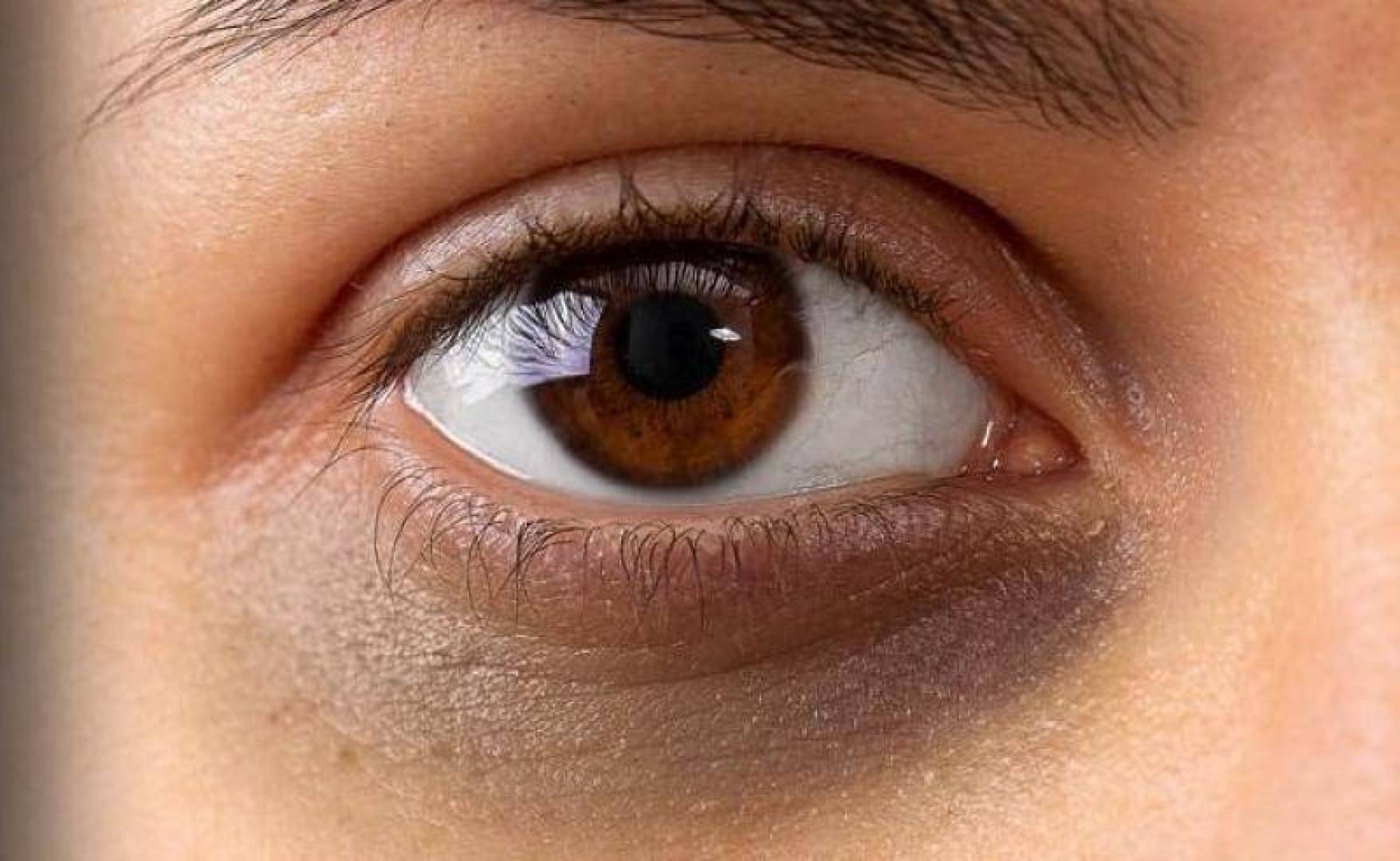 أسباب الهالات السوداء تحت العينين والمخاطر الصحية المرتبطة بها