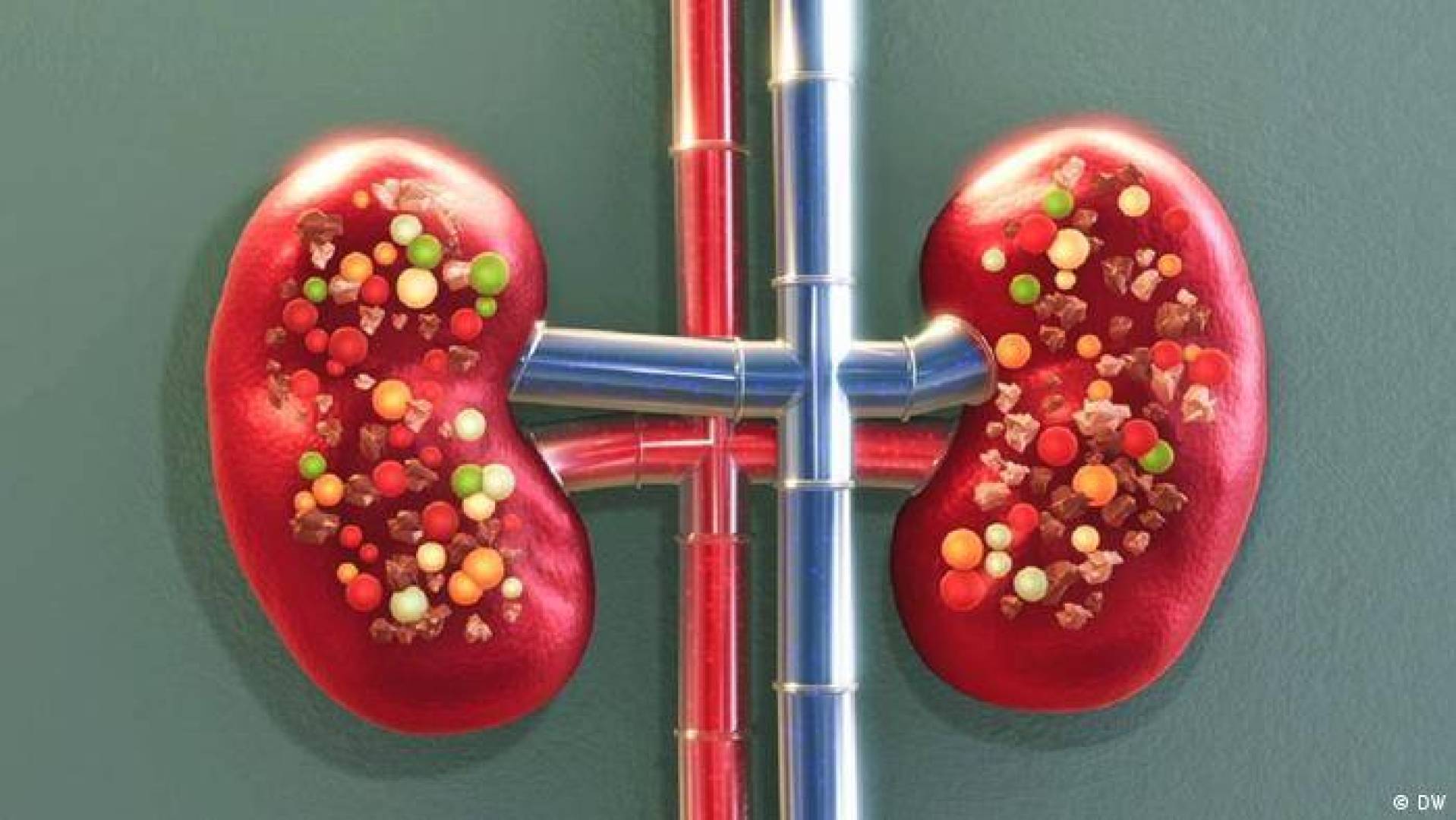 أسباب تشكل حصوات الكلى وطرق الوقاية منها ؟