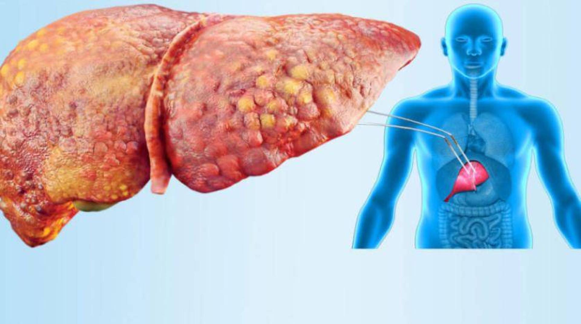 علامات تحذيرية في الفم تشير إلى إصابتك بمرض الكبد الدهني