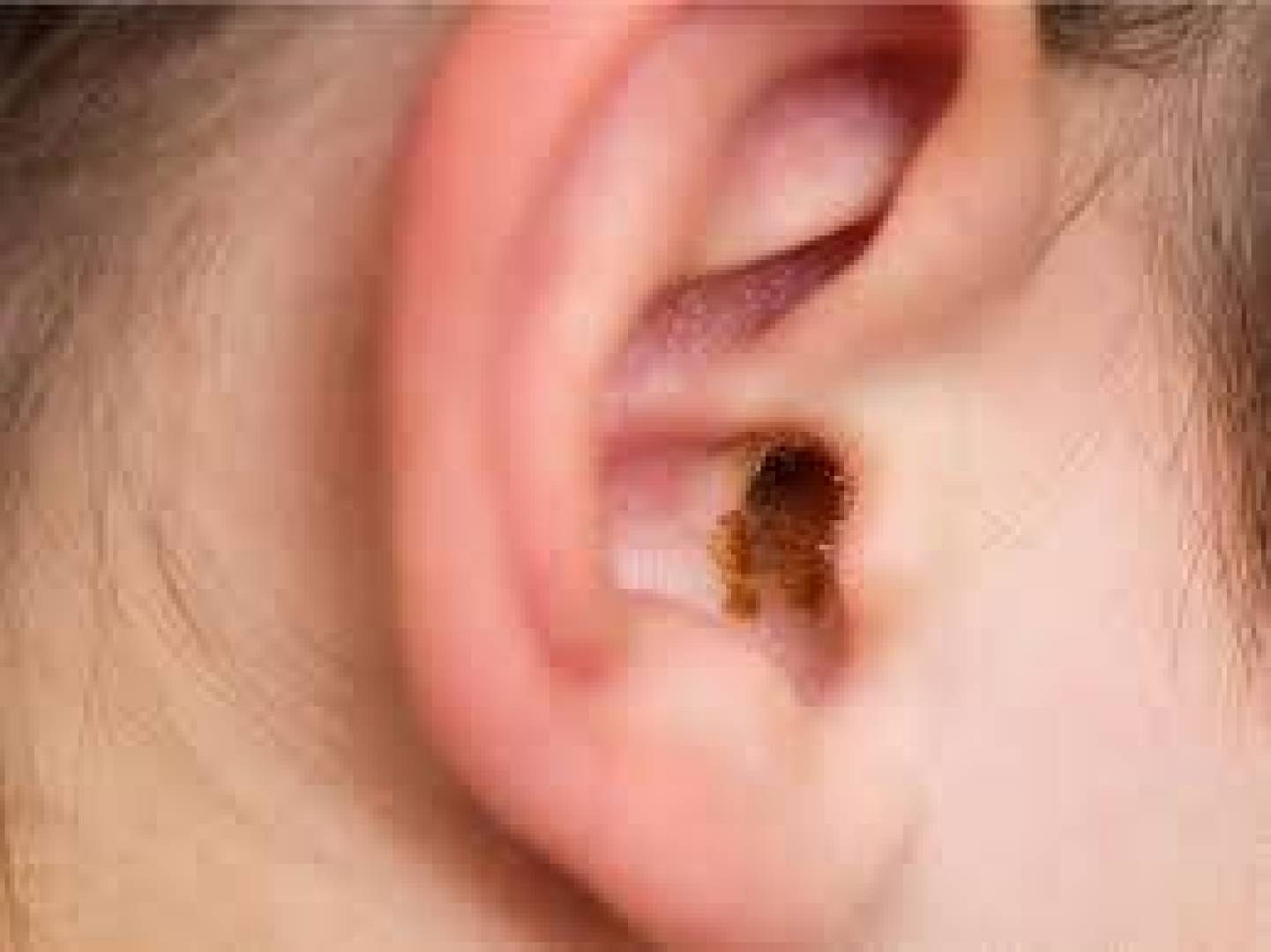ماهي الأعراض الشائعة لسدادة شمع الأذن وكيف يتم إزالتها منزليا ؟