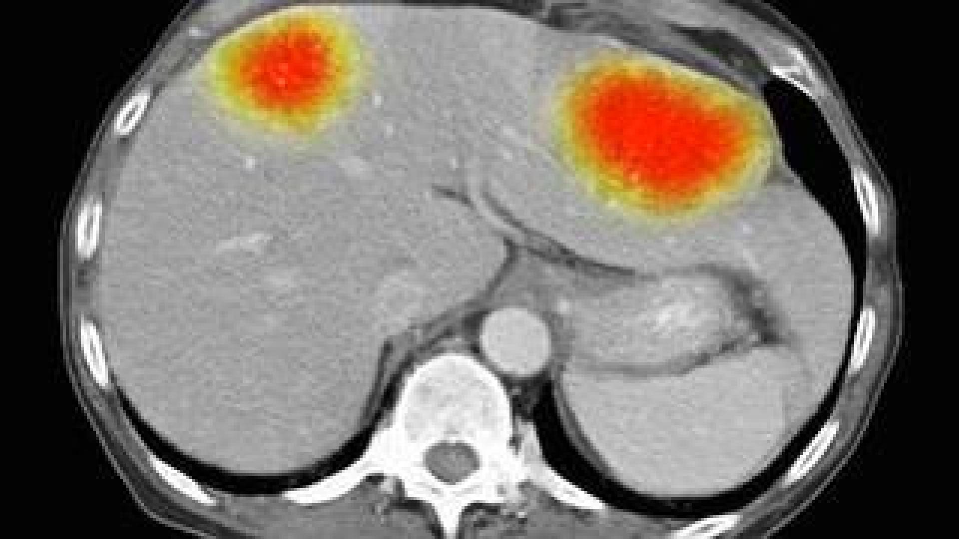 العلاج الكمومي بجزيئات الذهب: أمل جديد لمرضى سرطان الدماغ العدواني