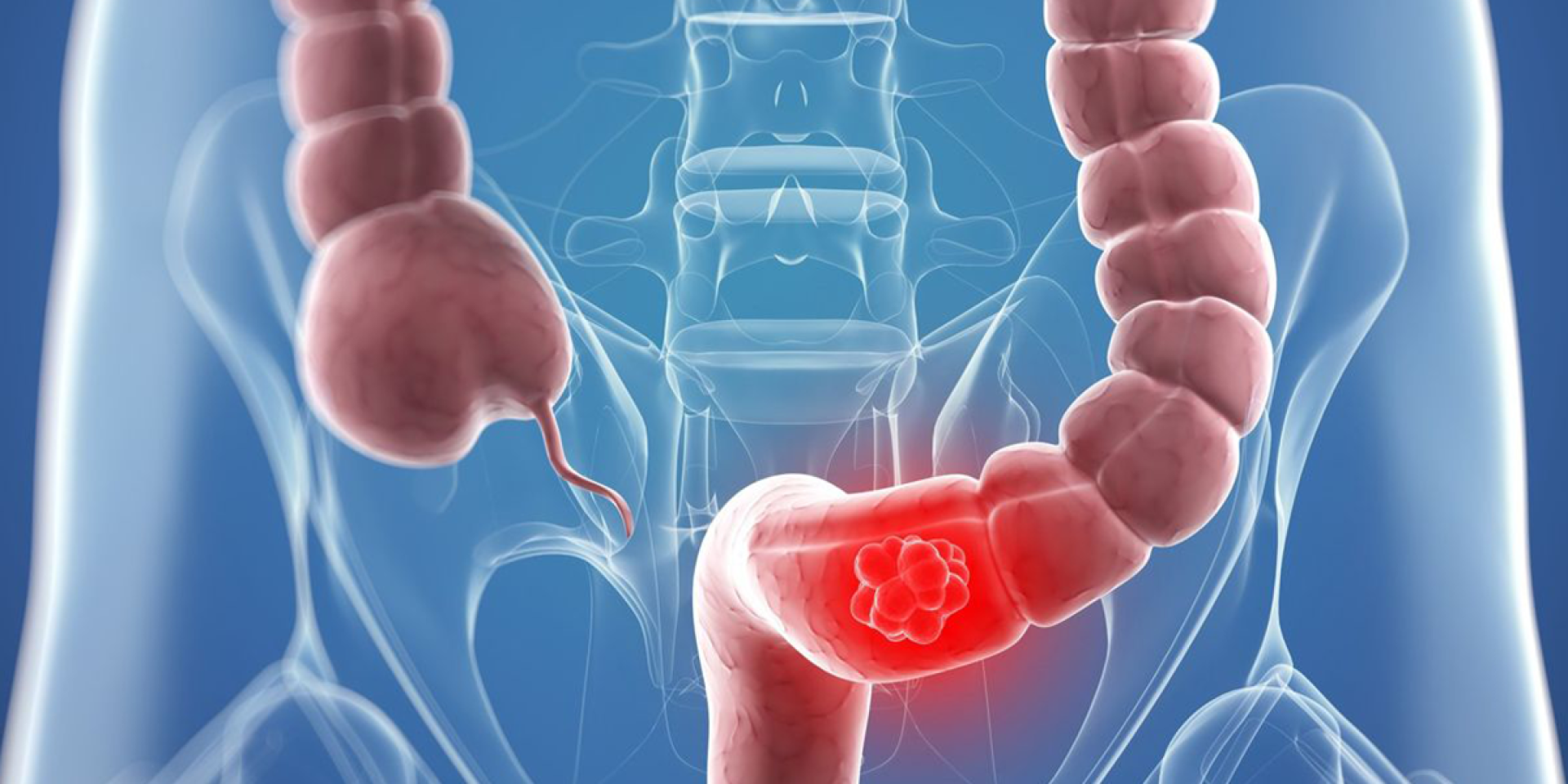 عقار جديد يعالج سرطان الأمعاء ويقلل من الحاجة للجراحة
