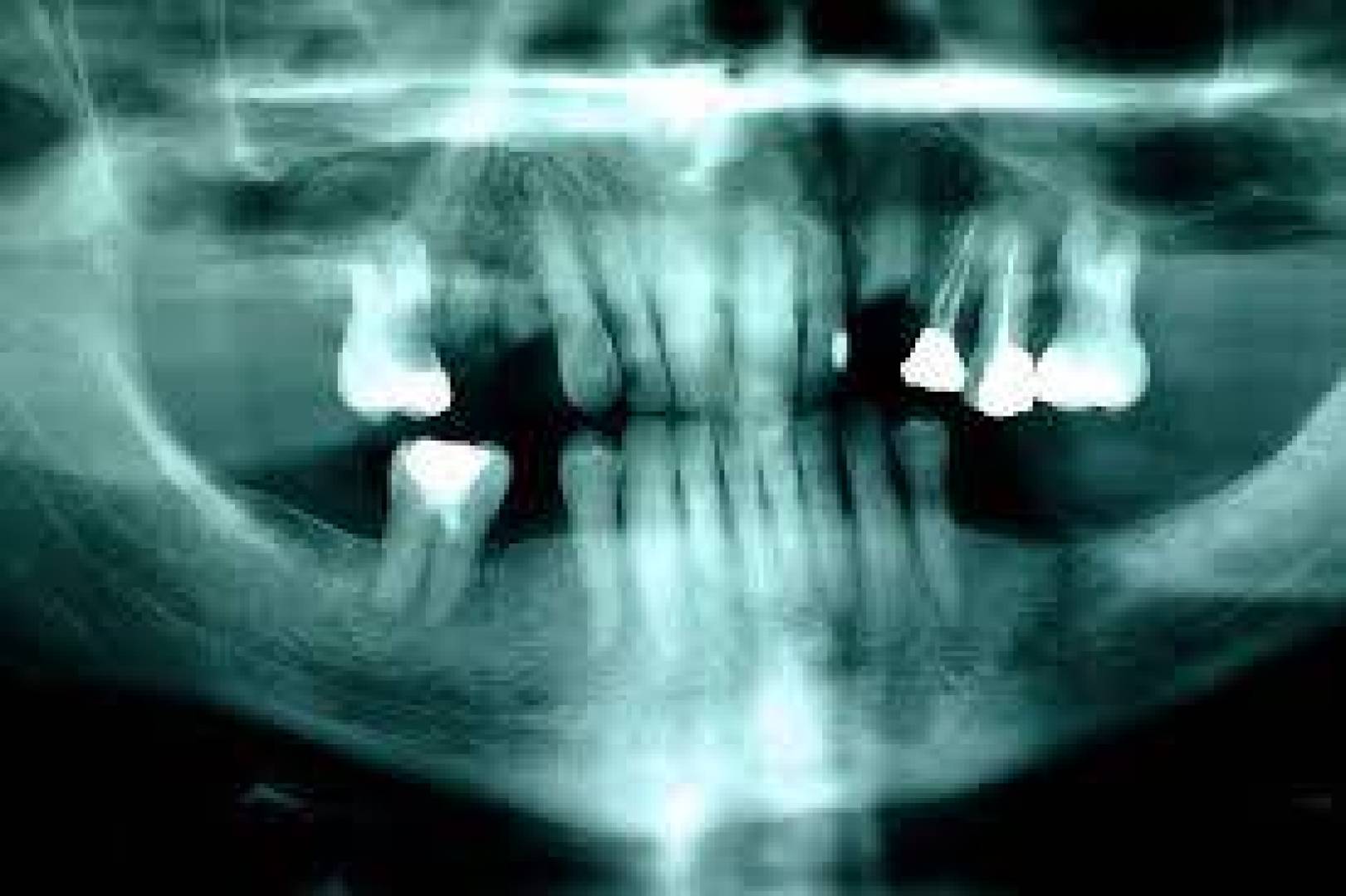 الخلايا الجذعية: حلاً ثوريًا لتسوس الأسنان
