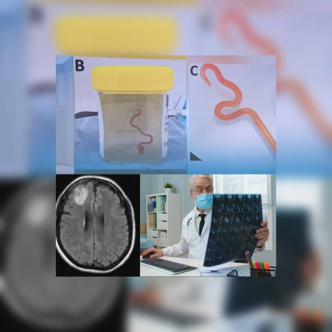 شاهد: أطباء أستراليون يعثرون في دماغ امرأة على دودة طفيلية يبلغ طولها ثمانية سنتيمترات