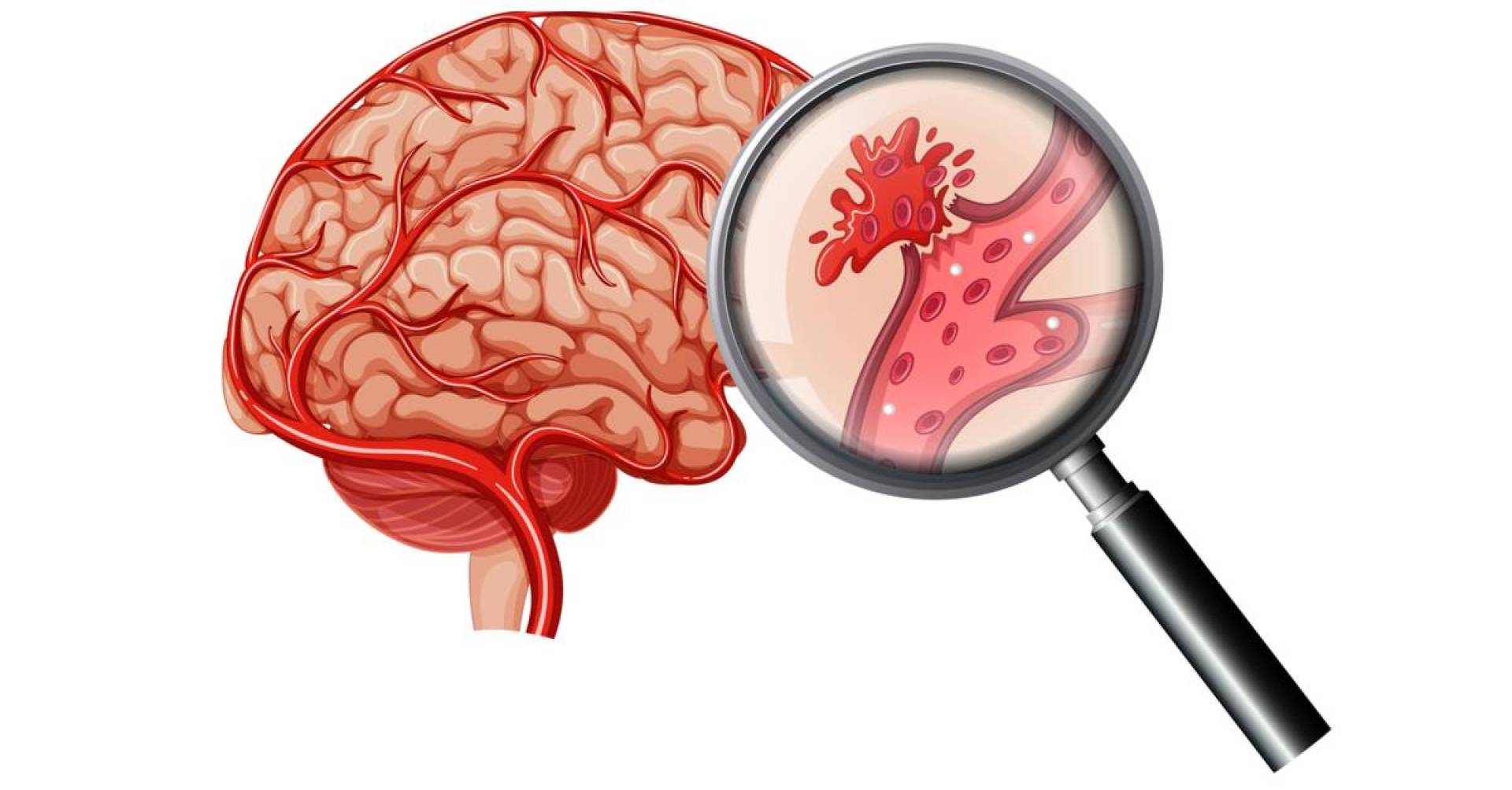 انتبه لهذه الأعراض ... فهي تدل على إصابتك بجلطة دماغية