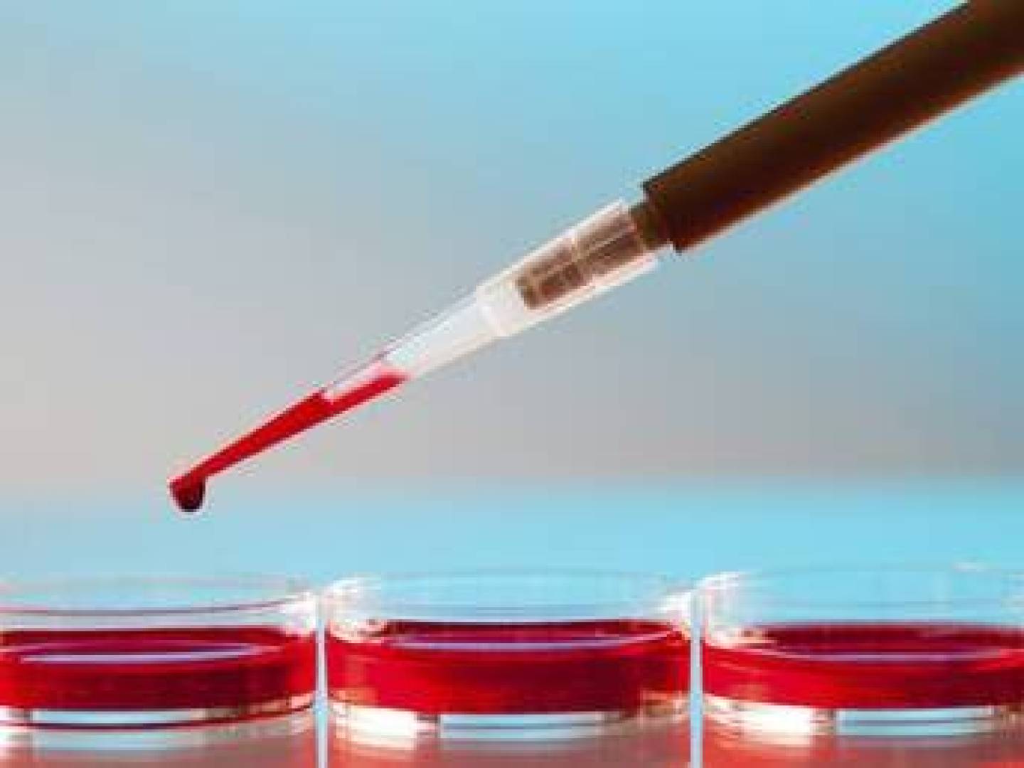 فصيلة دمك تؤثر على خطر إصابتك بالسكتة الدماغية