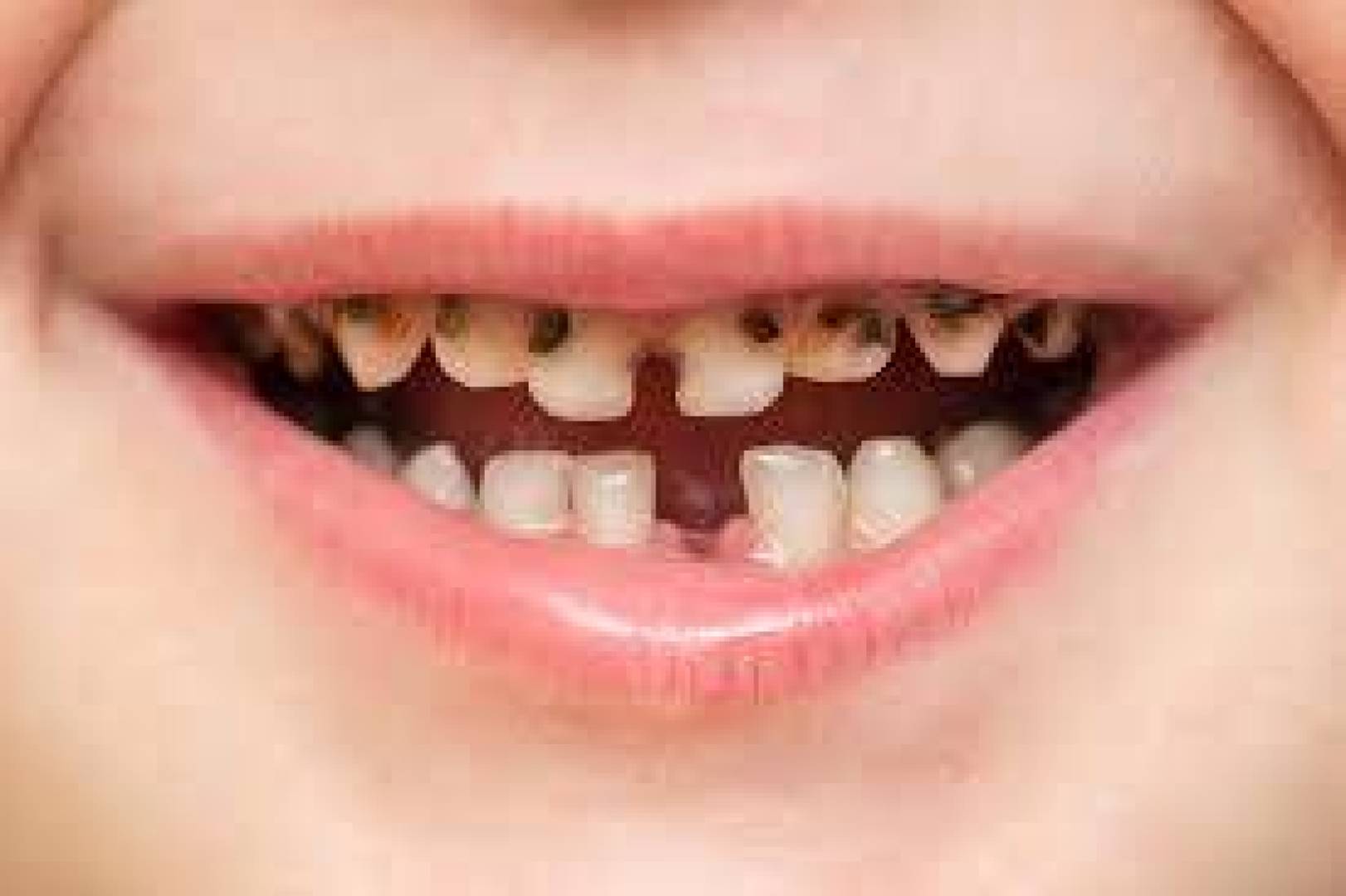 ابتكار تركيبات هلامية تمنع تسوس الأسنان