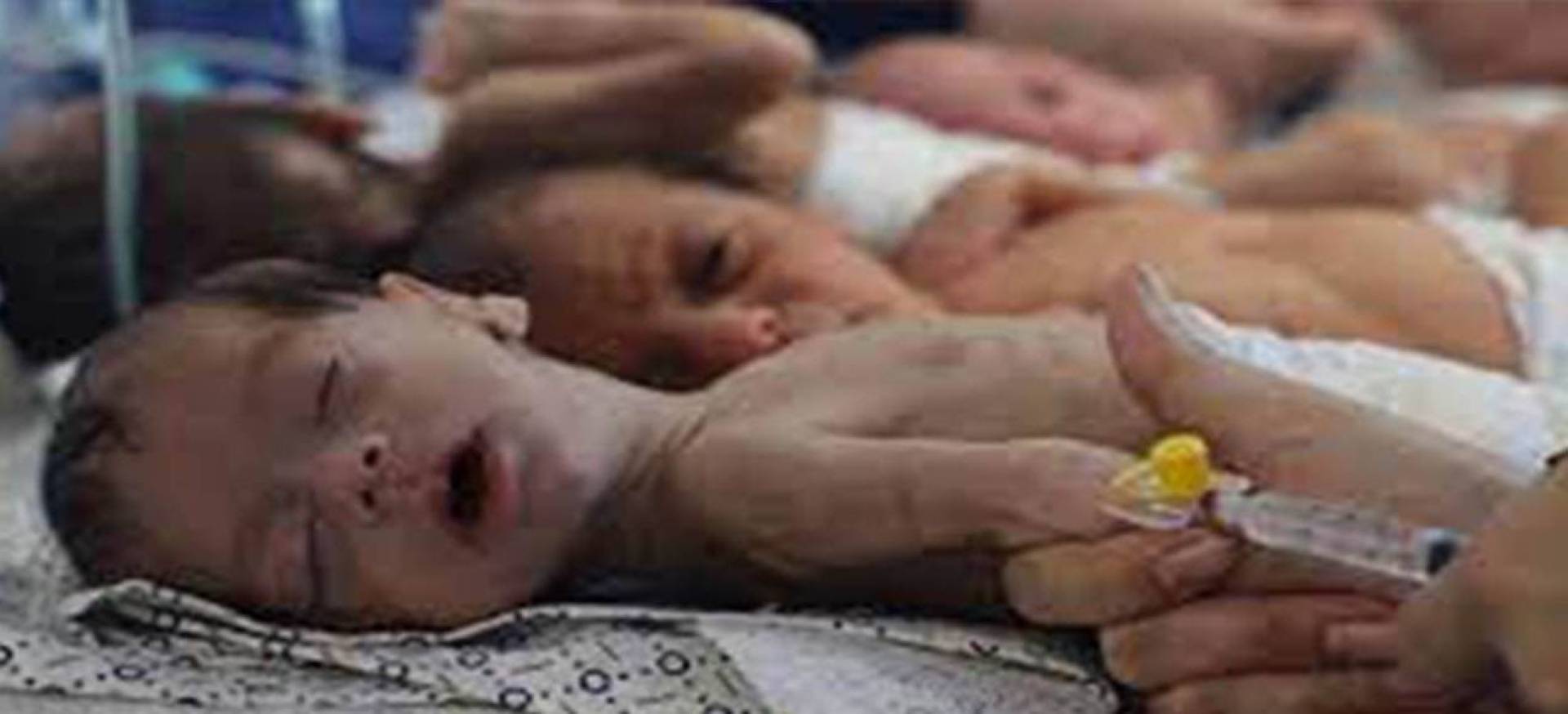 سوء التغذية والمجاعة شمال قطاع غزة تهدد حياة  50 طفلا