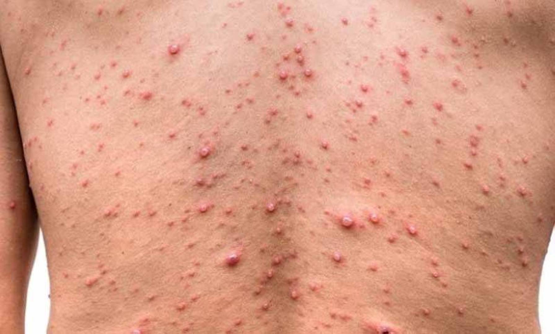 منظمة الصحة العالمية تدرس إمكانية إعلان فيروس جدري القرود كحالة طوارئ عالمية