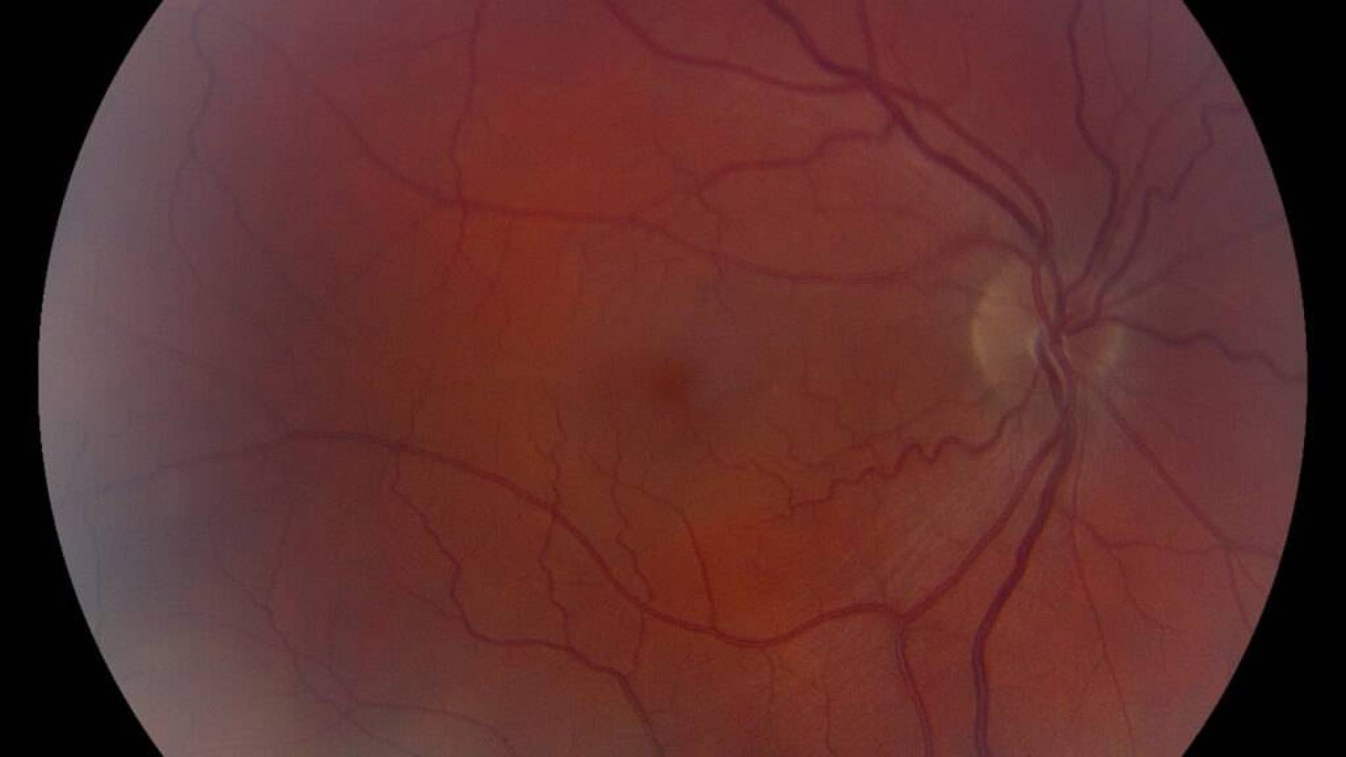 دراسة تربط بين Ozempic وزيادة خطر حالة العين التي يمكن أن تسبب فقدان البصر
