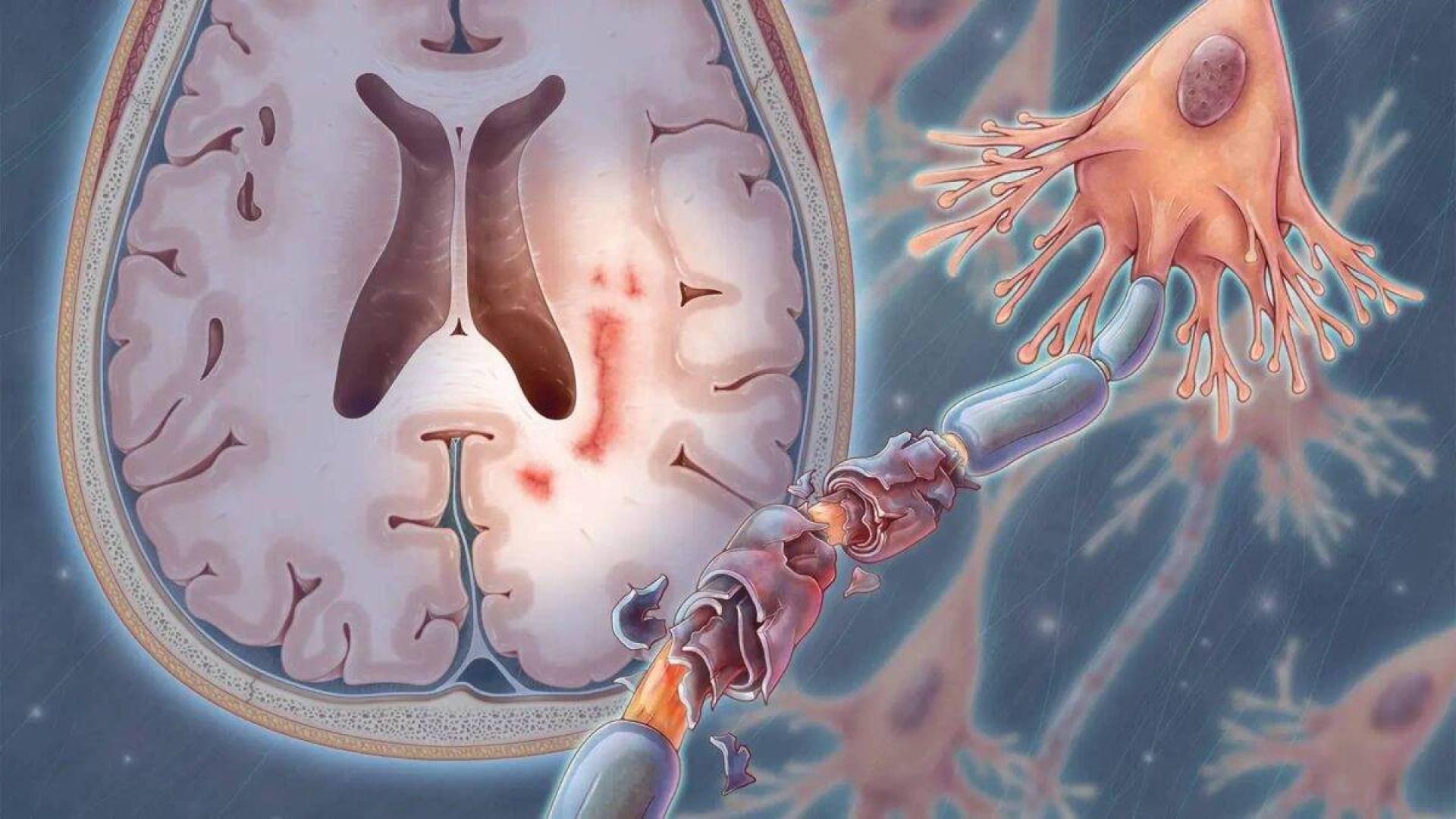 النساء أقل عرضة لتلقي علاجات التصلب المتعدد الفعالة مقارنة بالرجال