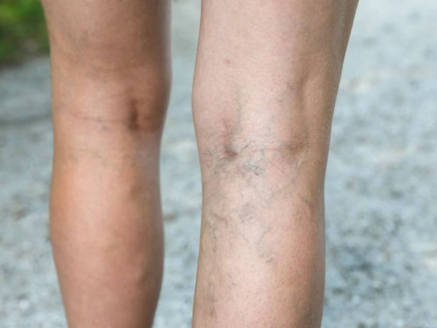 تعرف على أطعمة تساعد في تقليل دوالي الساقين وتحسين مظهرها