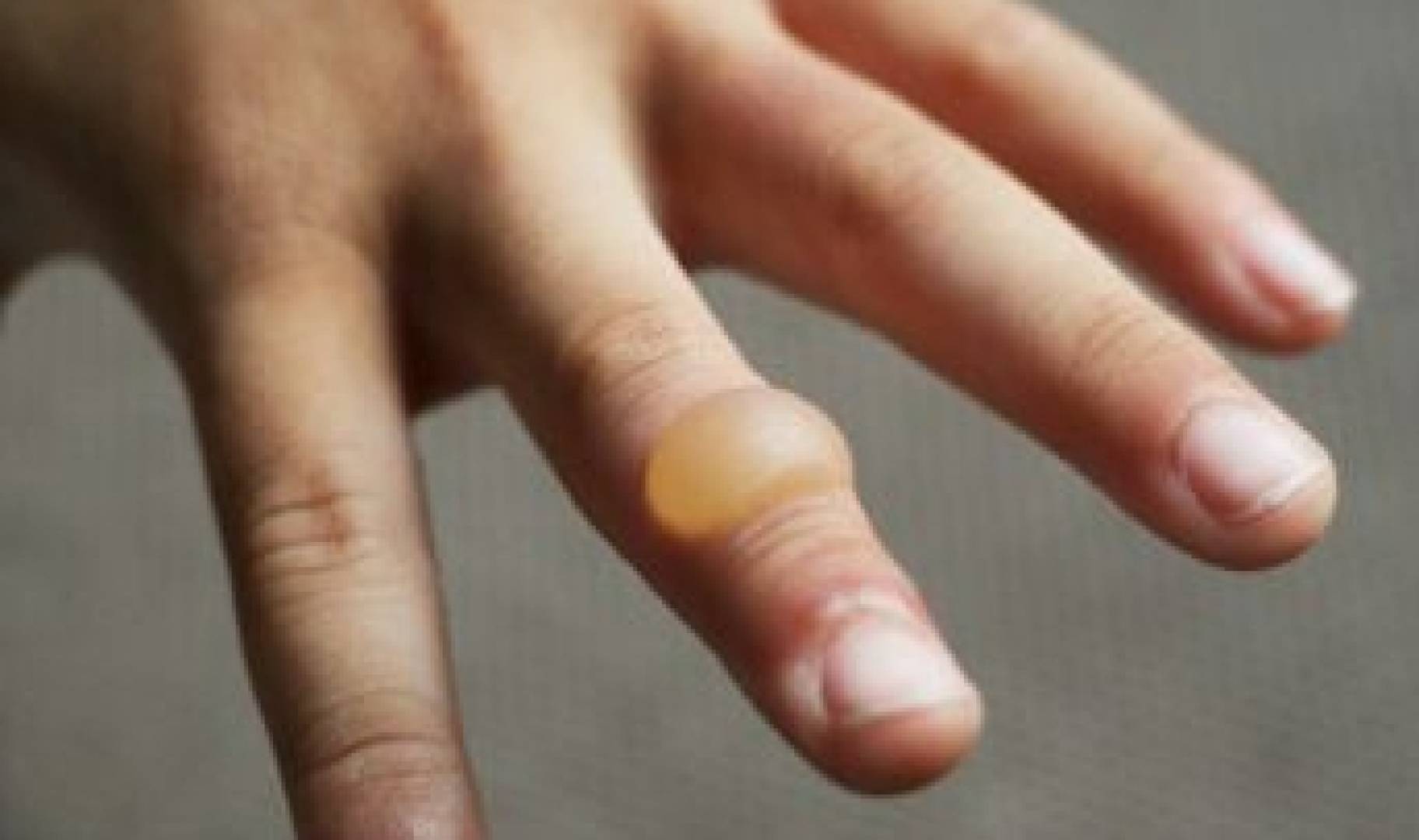 الإسعافات الأولية للحروق.. دليل شامل للآباء