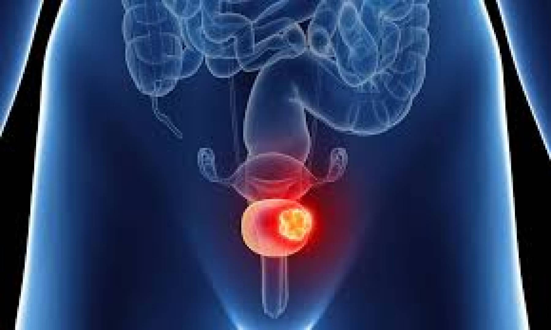 رغم التحفظات.. دواء جديد لسرطان المثانة يحصل على موافقة FDA