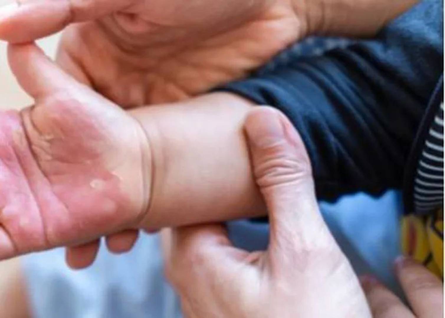 طرق آمنة وفعالة لعلاج الحروق لدى الأطفال في المنزل