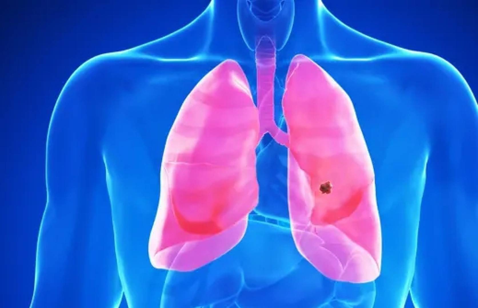 دواء فموي يحقق اختراقا في علاج سرطان الرئة النادر المنتشر إلى الدماغ